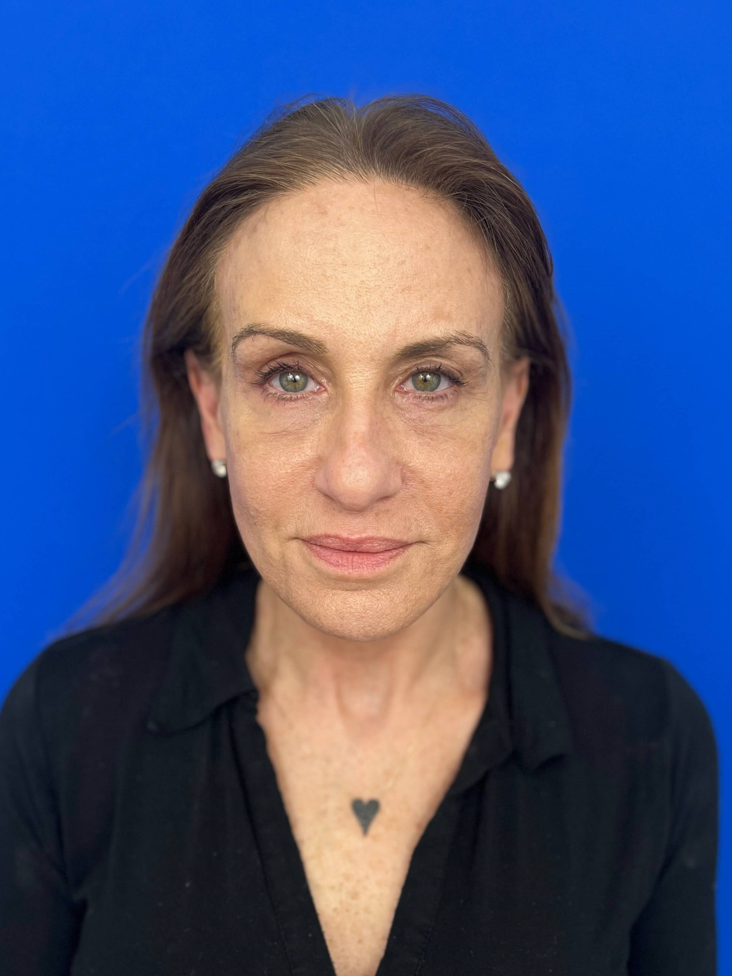 Beverly Hills, CA Patient Undergoes Brow, Face, and Neck Lifts