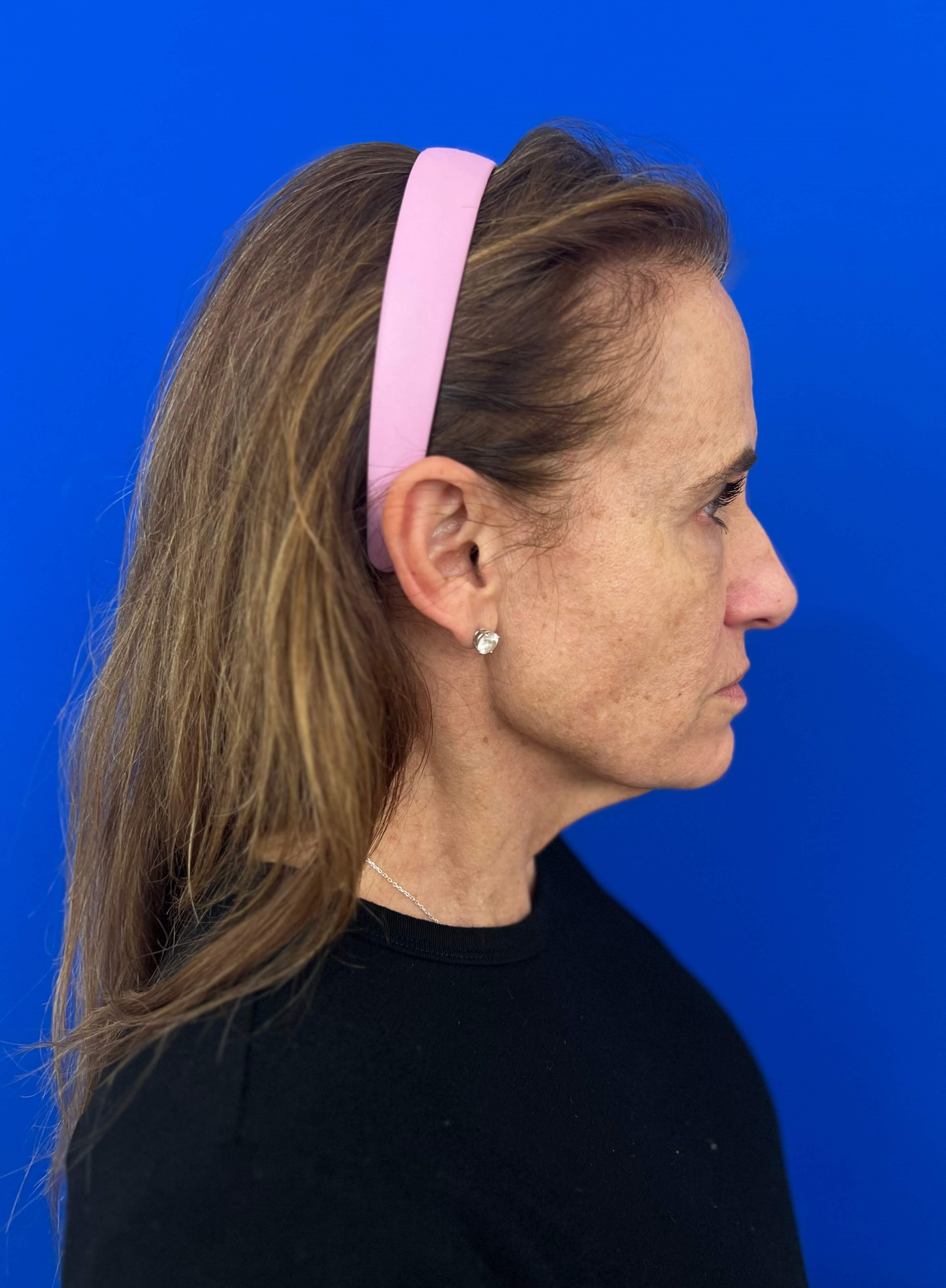 Beverly Hills, CA Patient Undergoes Brow, Face, and Neck Lifts — before, view 2