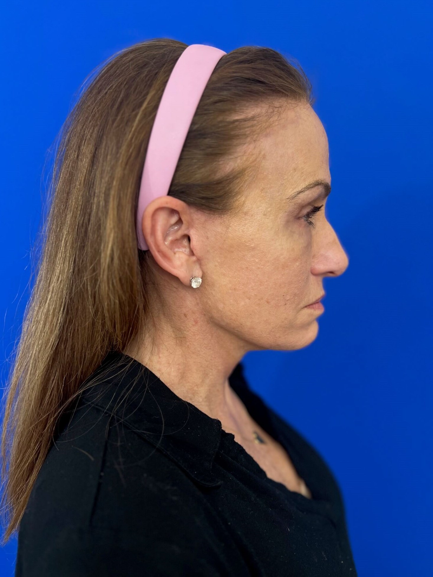 Beverly Hills, CA Patient Undergoes Brow, Face, and Neck Lifts — after, view 2