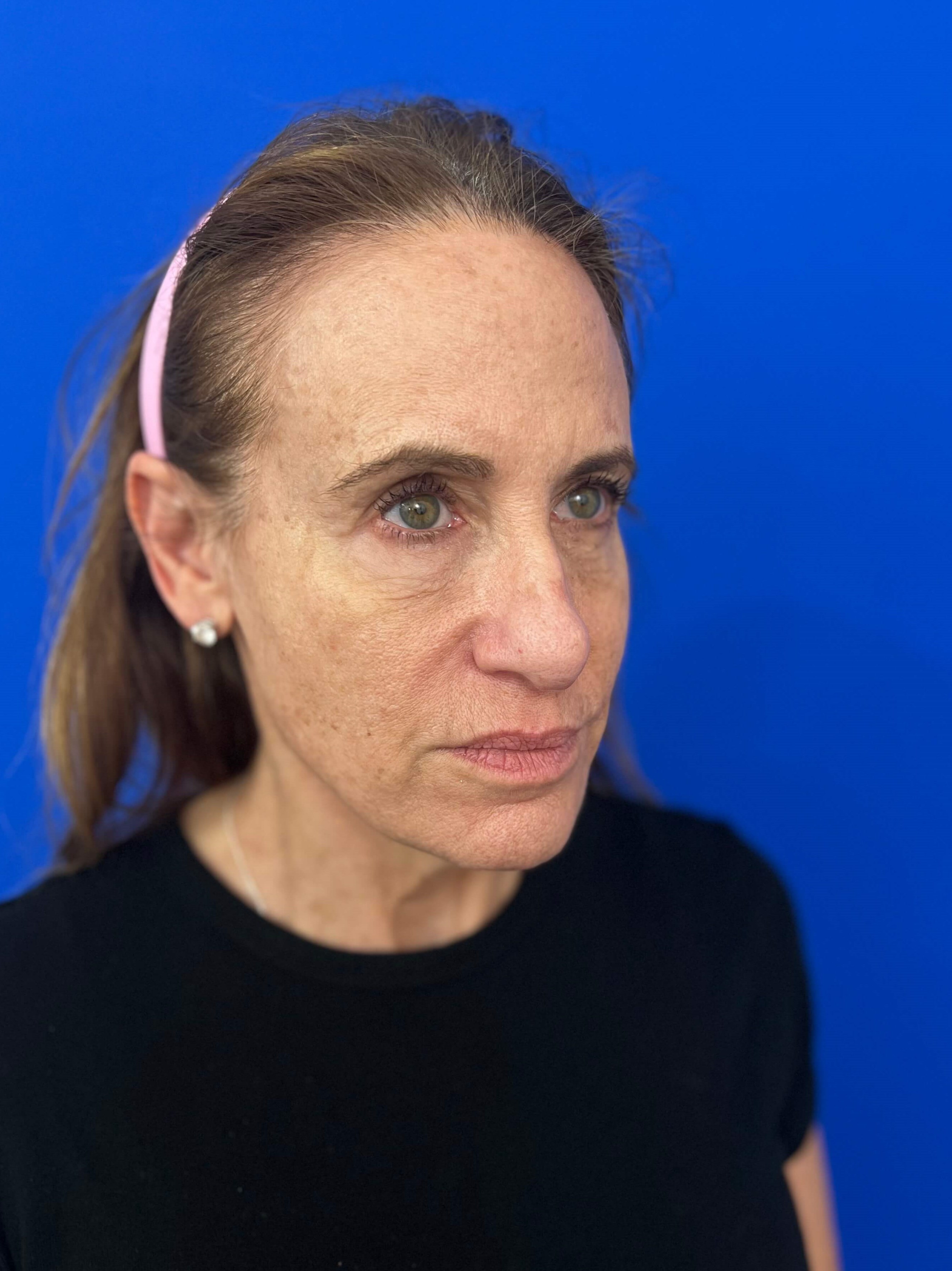 Beverly Hills, CA Patient Undergoes Brow, Face, and Neck Lifts — before, view 3