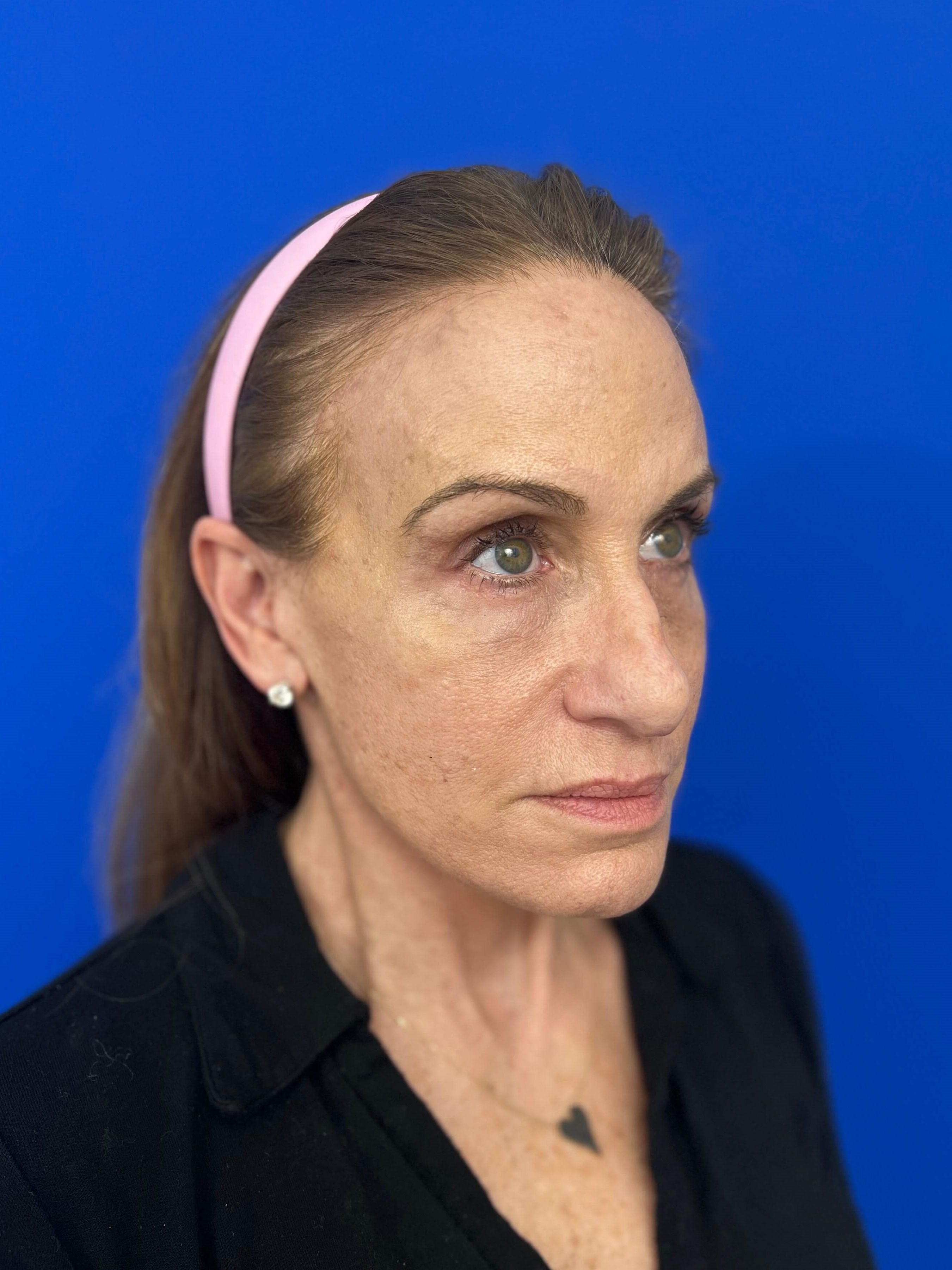 Beverly Hills, CA Patient Undergoes Brow, Face, and Neck Lifts — after, view 3