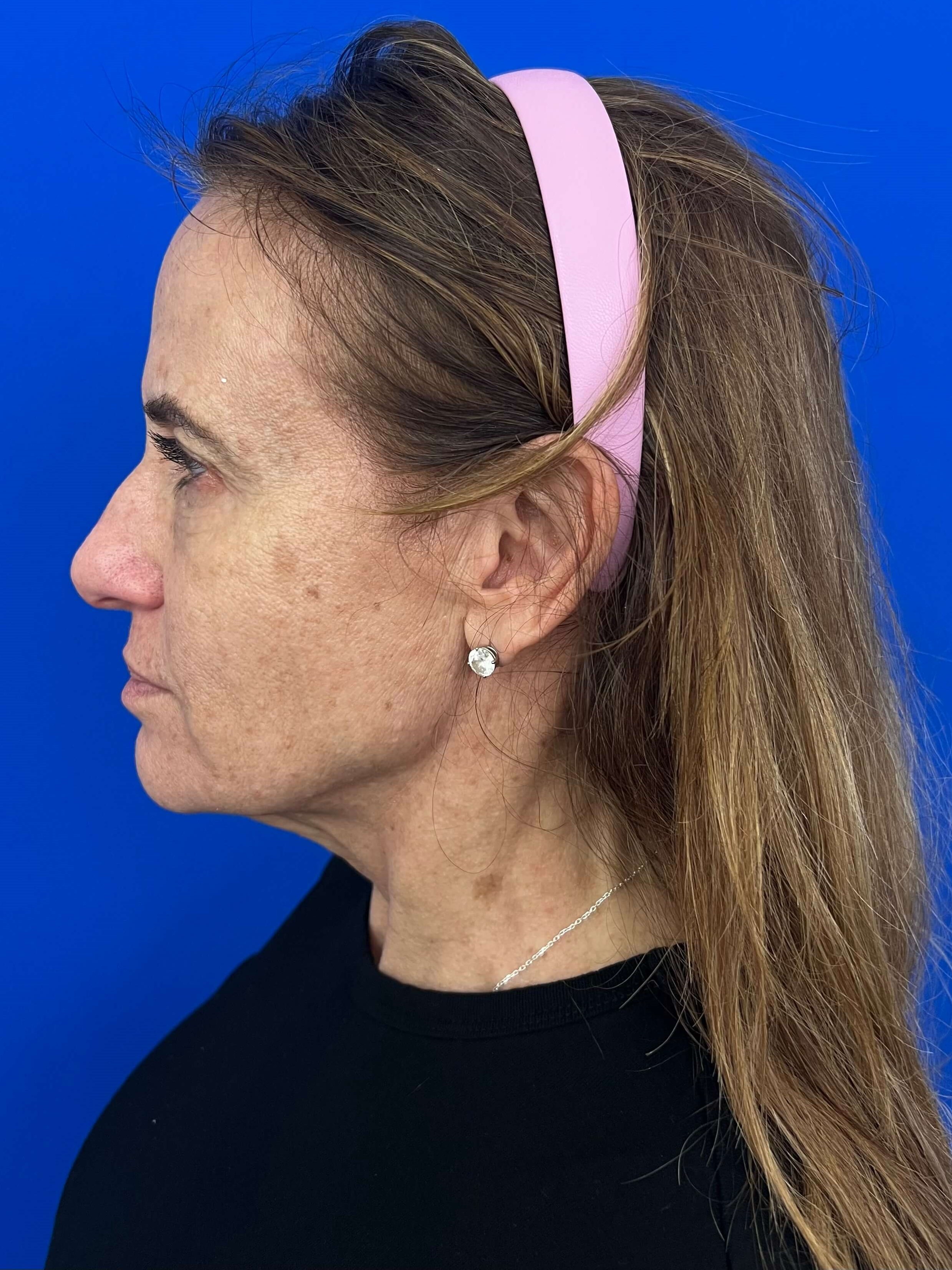 Beverly Hills, CA Patient Undergoes Brow, Face, and Neck Lifts — before, view 4