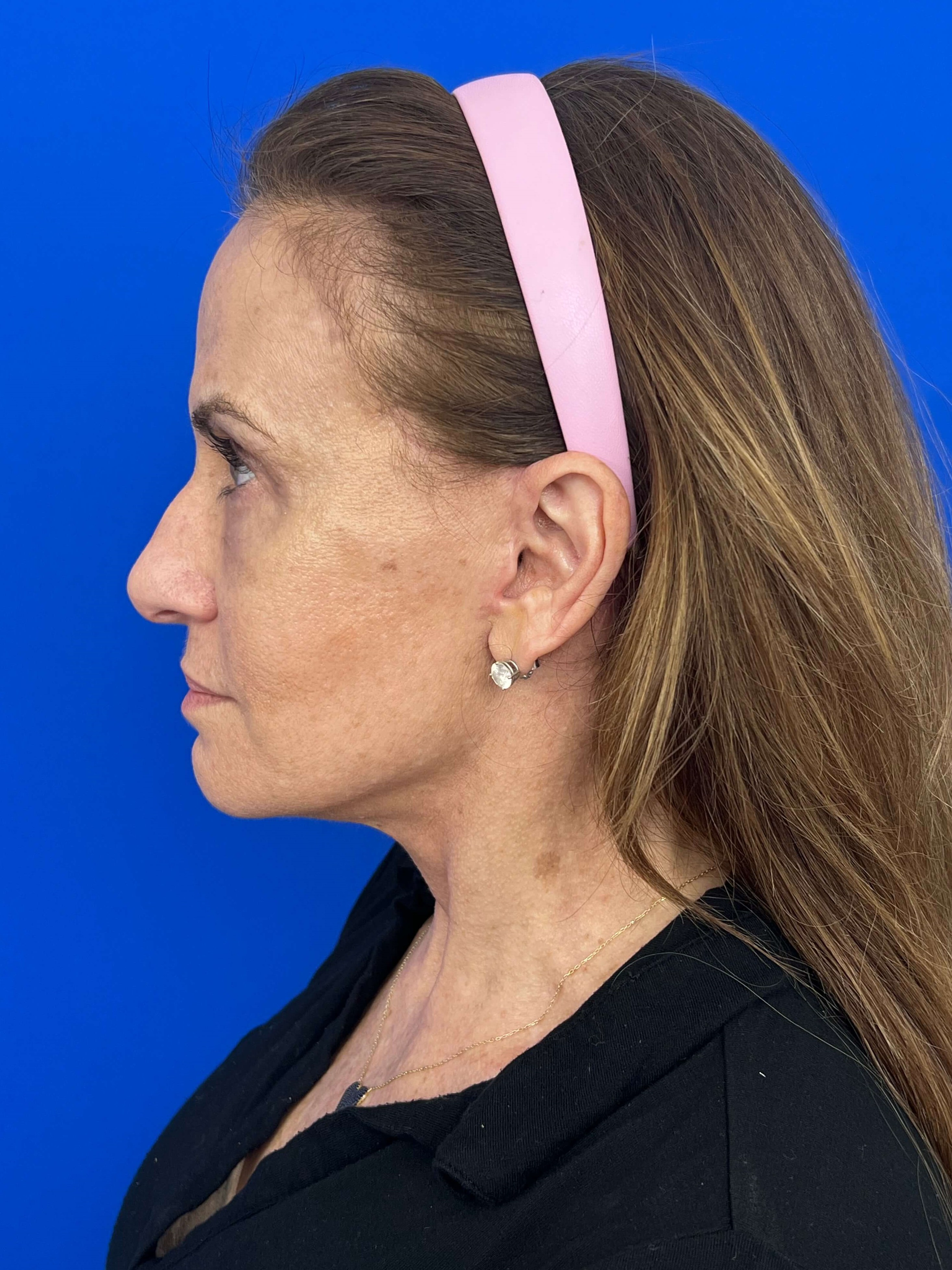Beverly Hills, CA Patient Undergoes Brow, Face, and Neck Lifts — after, view 4