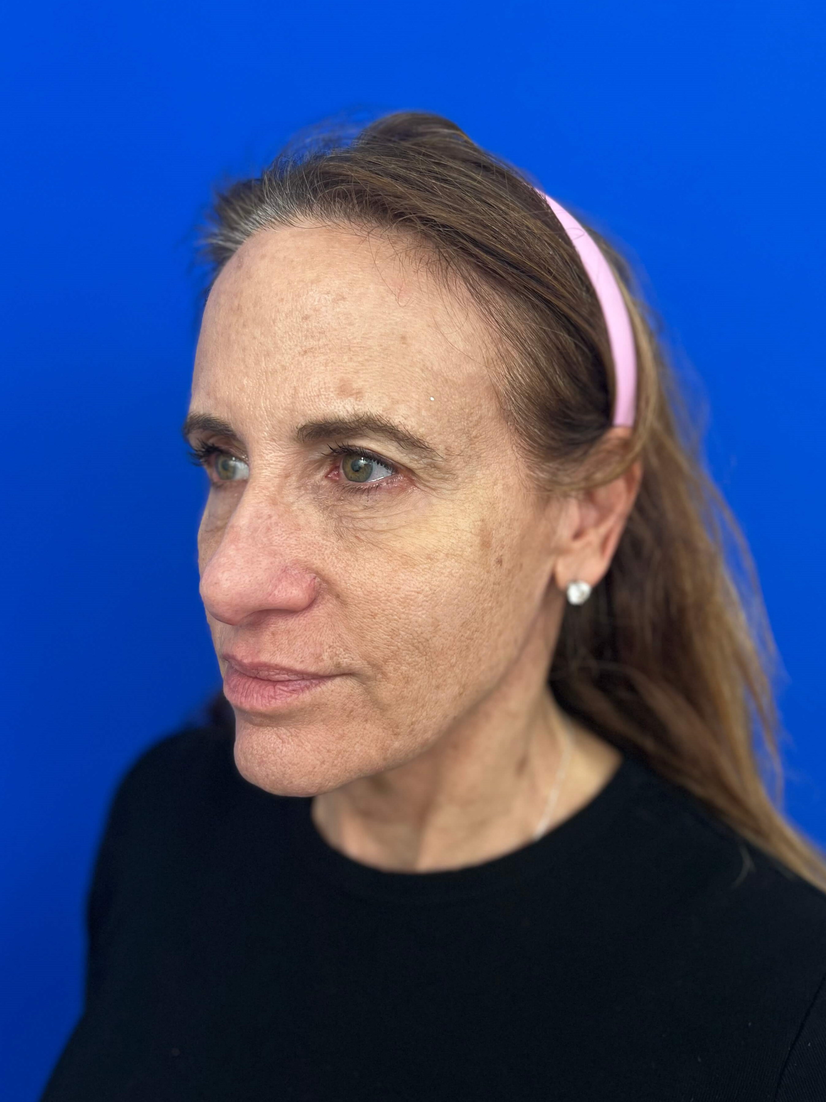 Beverly Hills, CA Patient Undergoes Brow, Face, and Neck Lifts — before, view 5