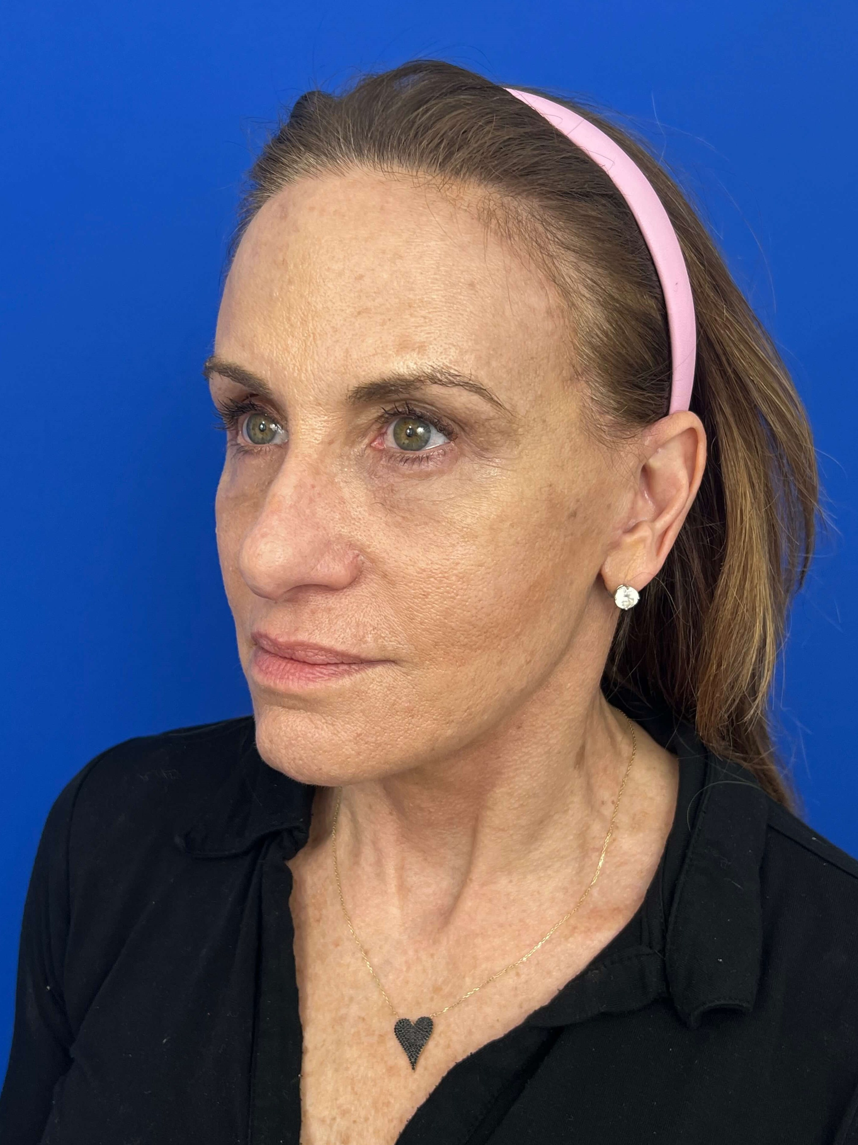 Beverly Hills, CA Patient Undergoes Brow, Face, and Neck Lifts — after, view 5