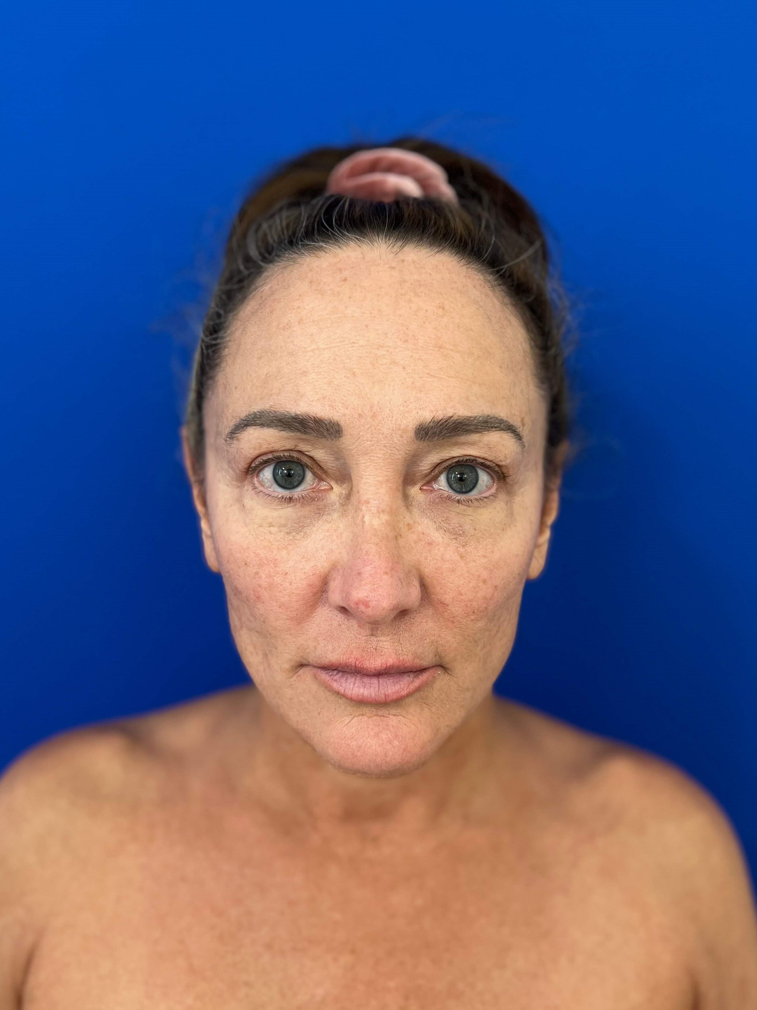Deep Plane Face and Neck Lift with Upper and Lower Bleph, Lower with Fat Transposition