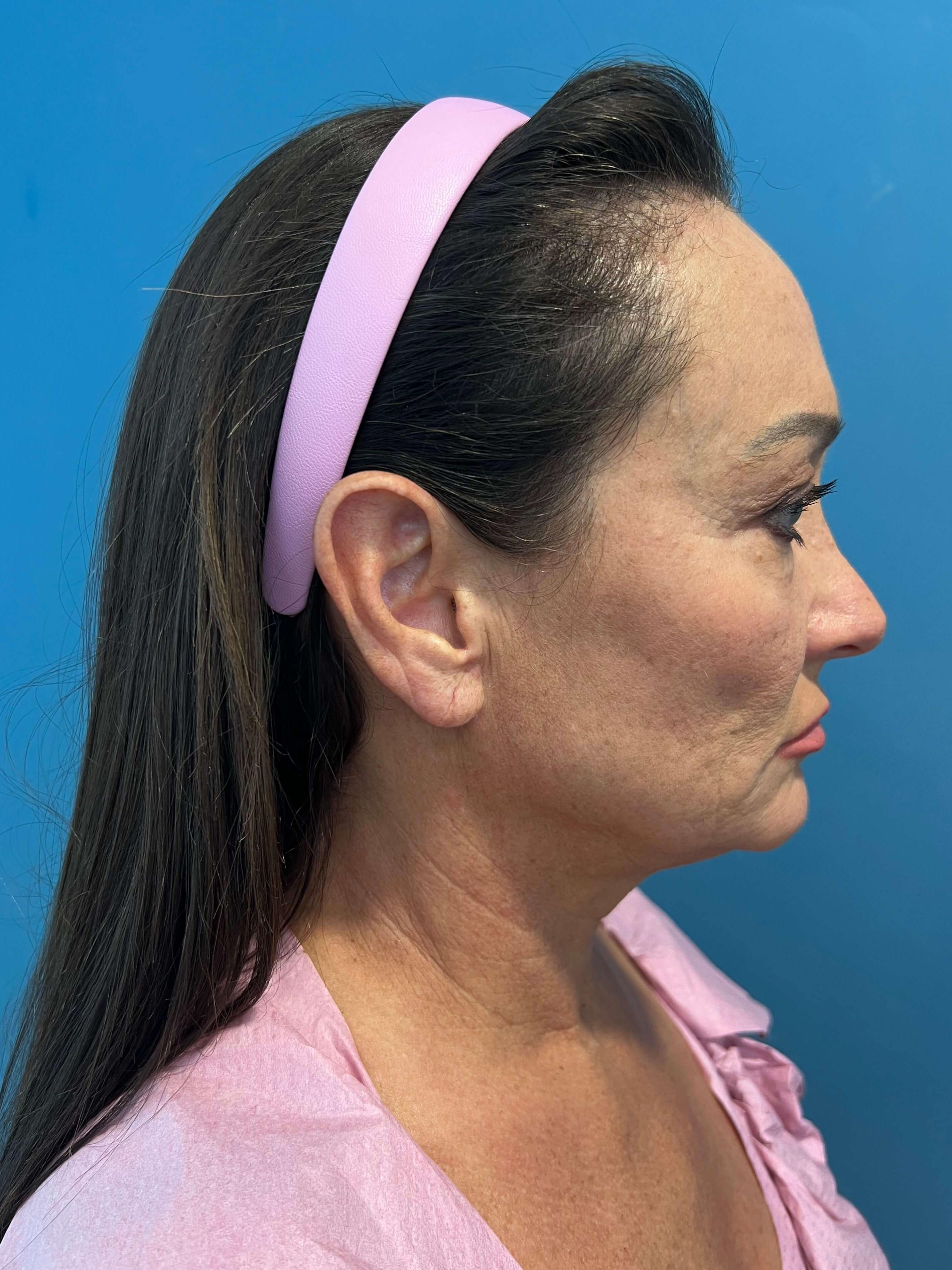 Deep Plane Face and Neck Lift with Upper and Lower Bleph, Lower with Fat Transposition — before, view 2
