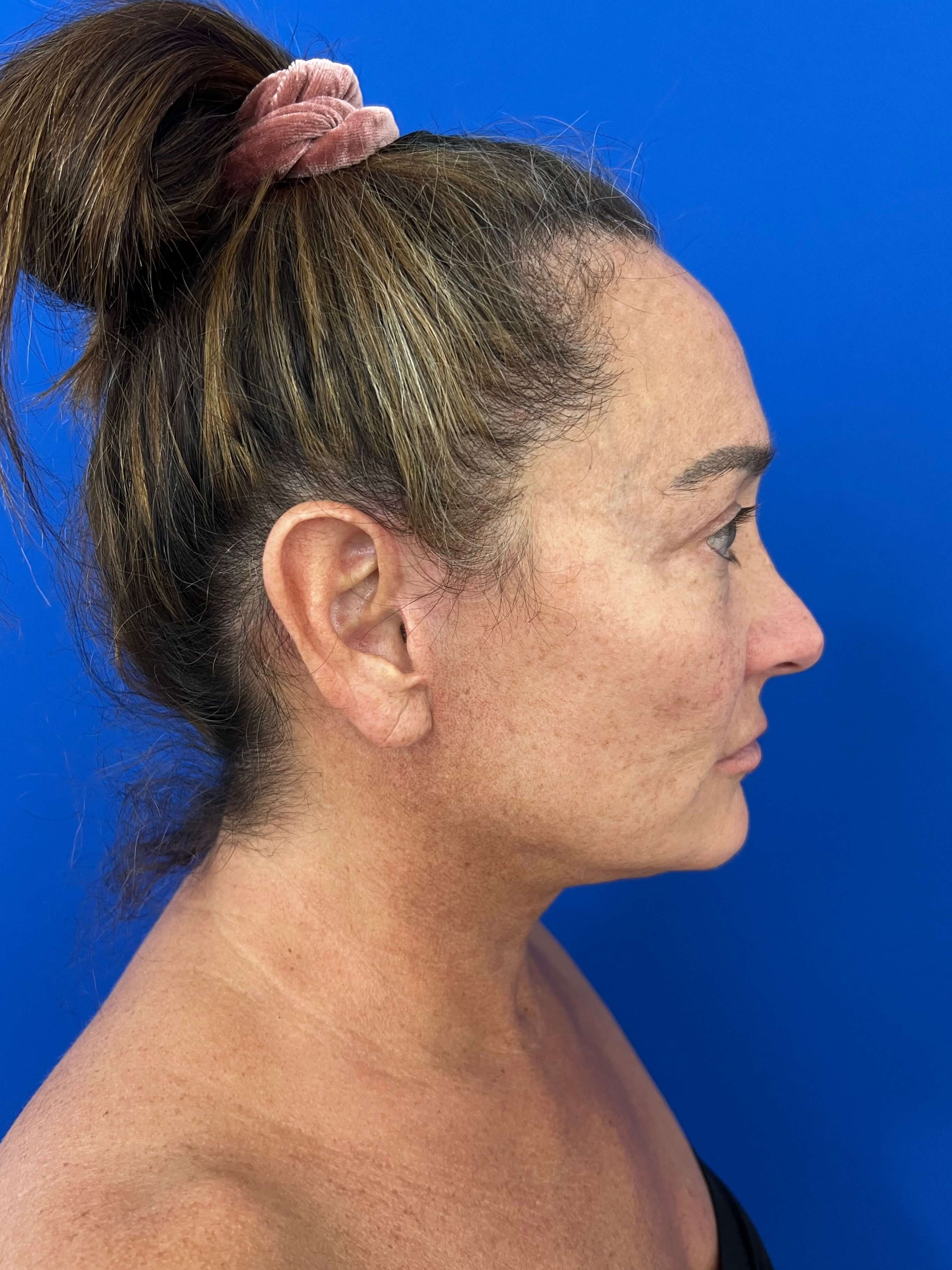 Deep Plane Face and Neck Lift with Upper and Lower Bleph, Lower with Fat Transposition — after, view 2