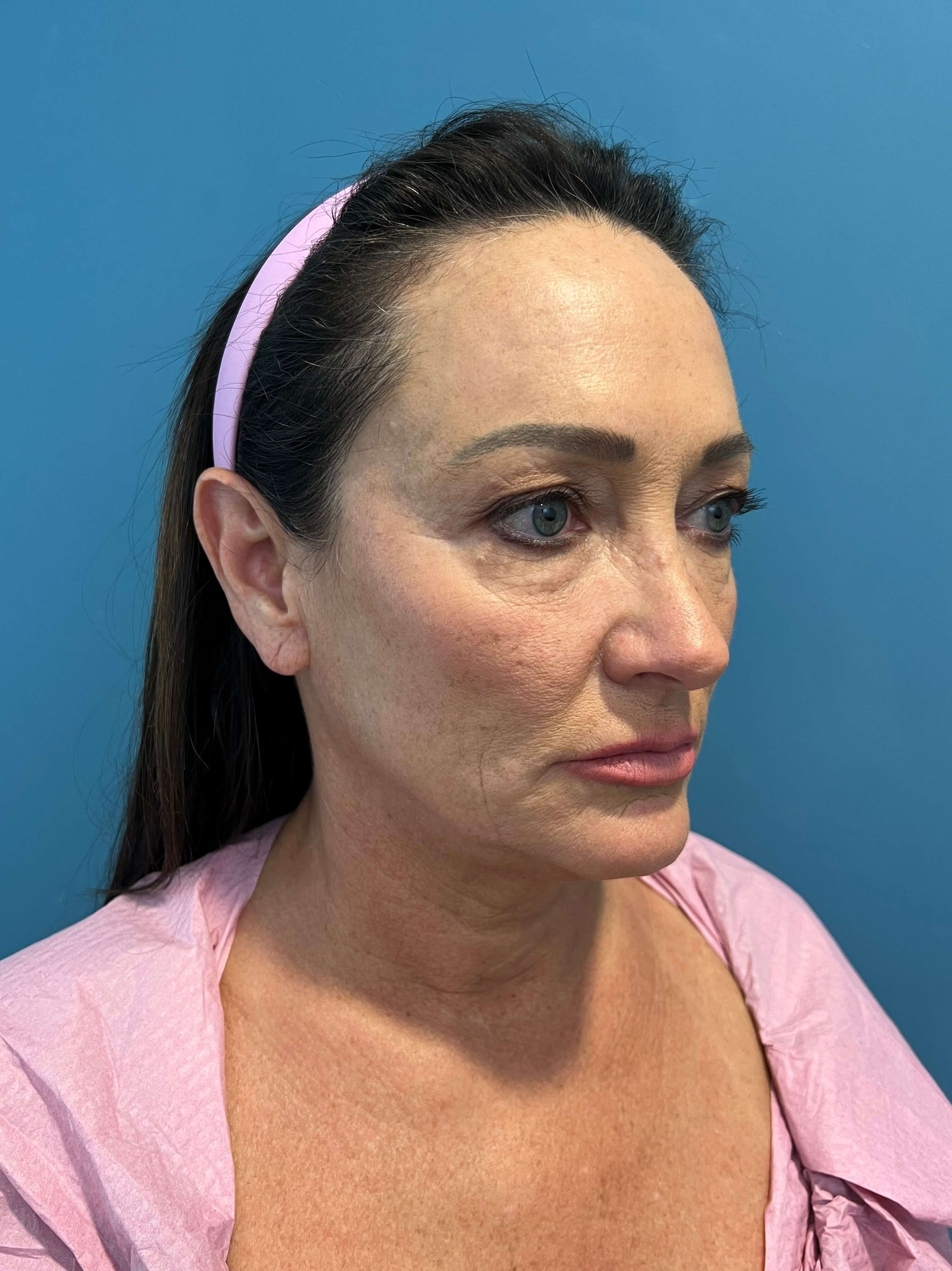 Deep Plane Face and Neck Lift with Upper and Lower Bleph, Lower with Fat Transposition — before, view 3