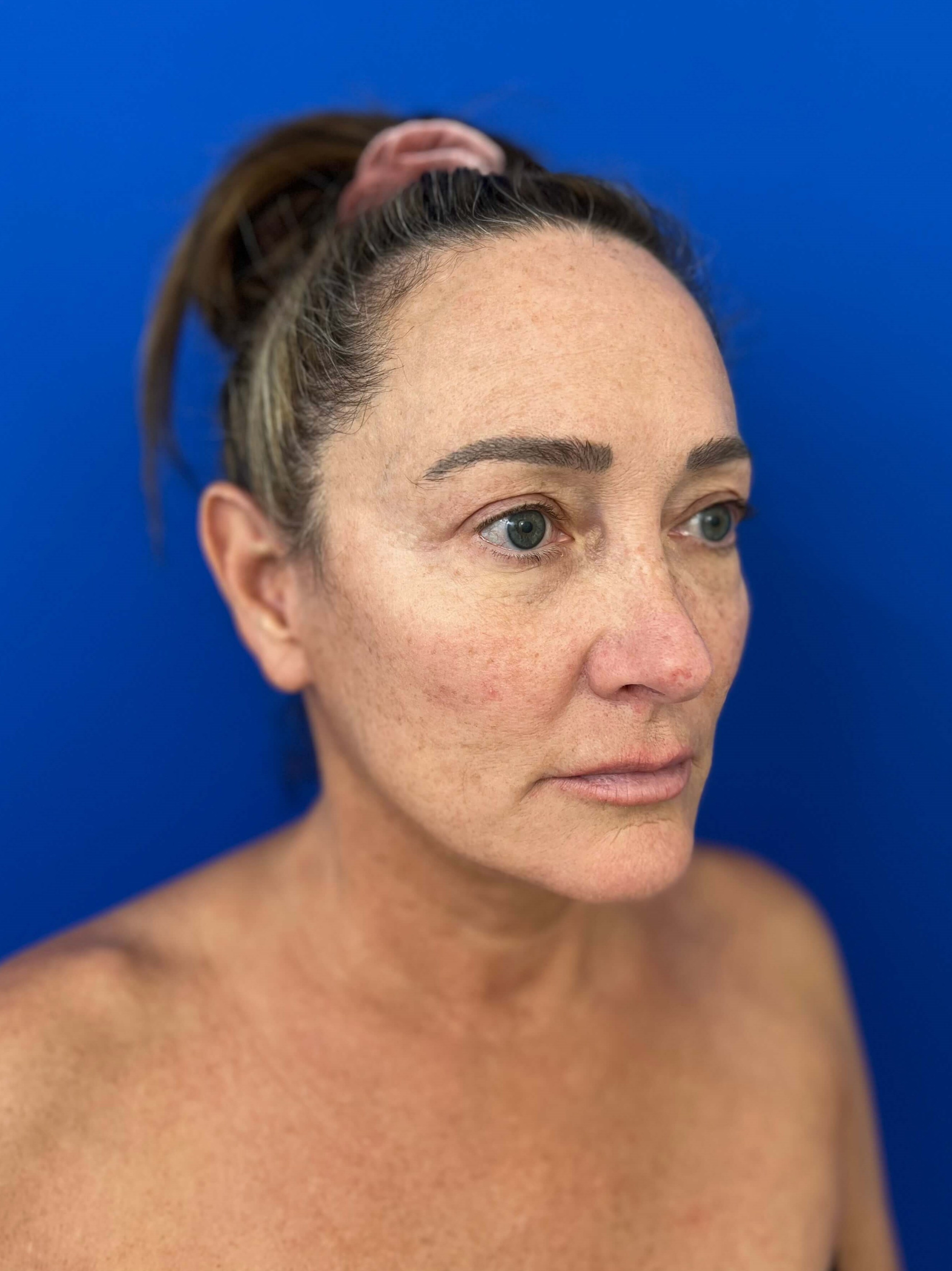 Deep Plane Face and Neck Lift with Upper and Lower Bleph, Lower with Fat Transposition — after, view 3
