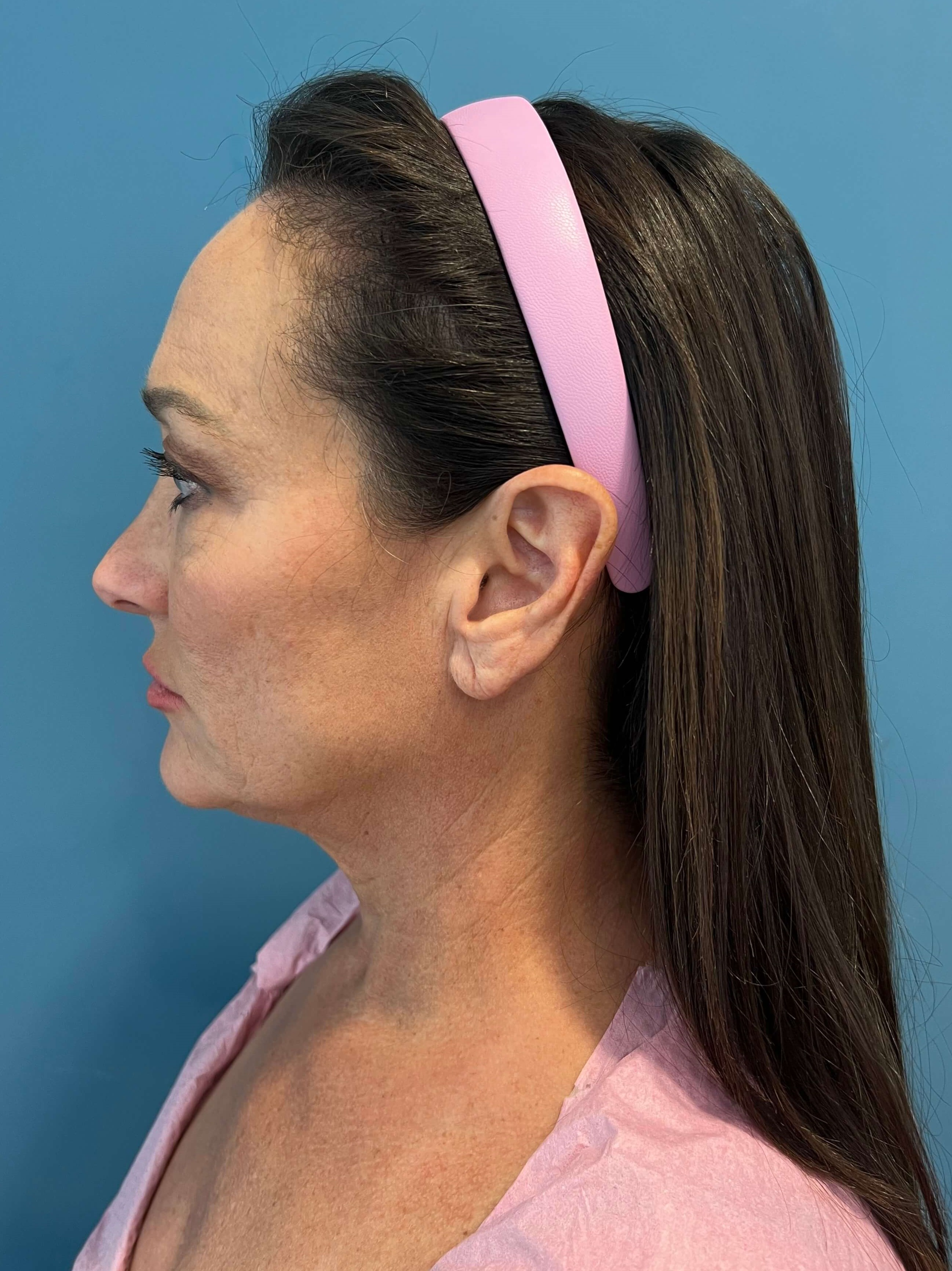Deep Plane Face and Neck Lift with Upper and Lower Bleph, Lower with Fat Transposition — before, view 4