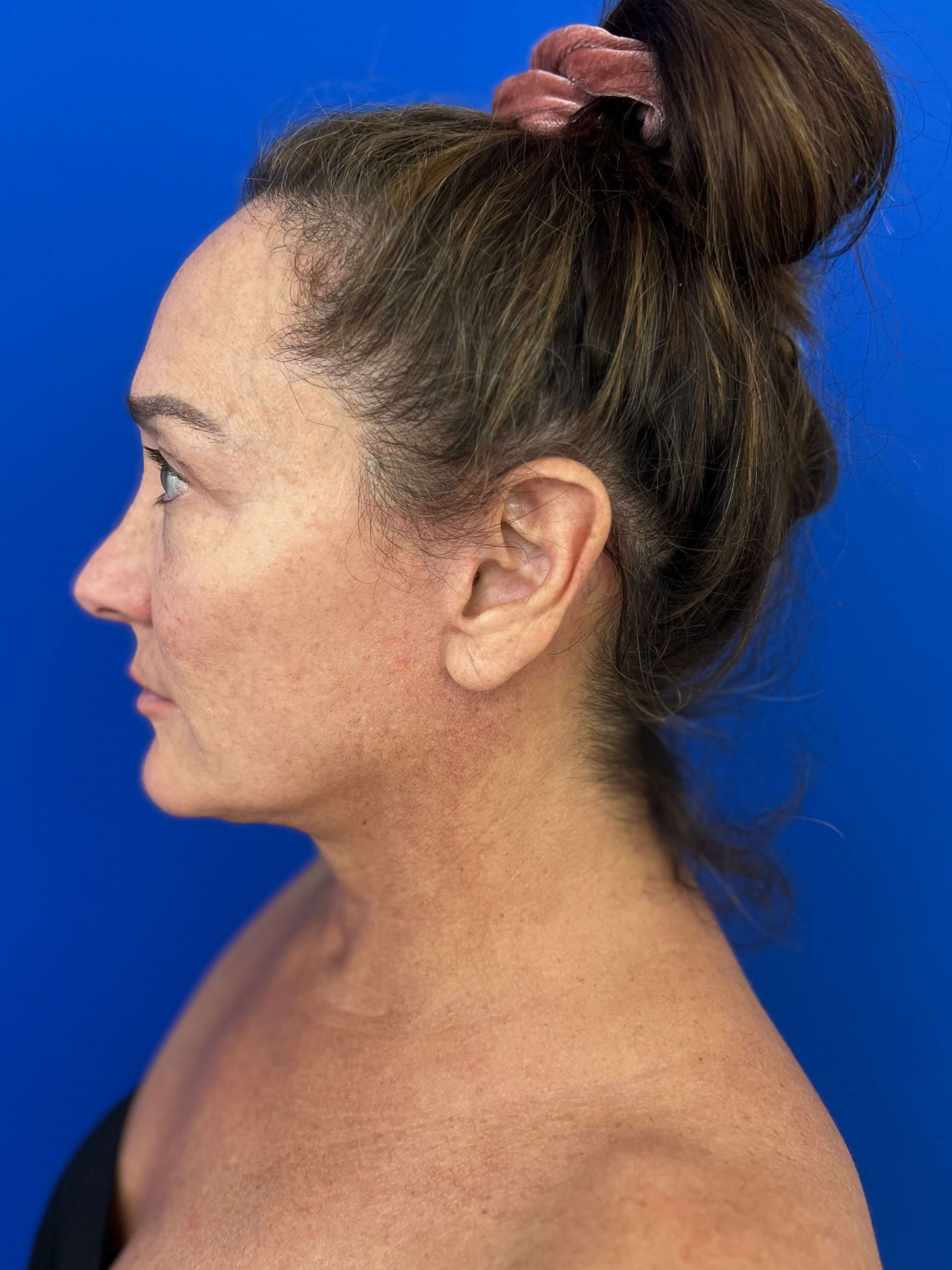 Deep Plane Face and Neck Lift with Upper and Lower Bleph, Lower with Fat Transposition — after, view 4