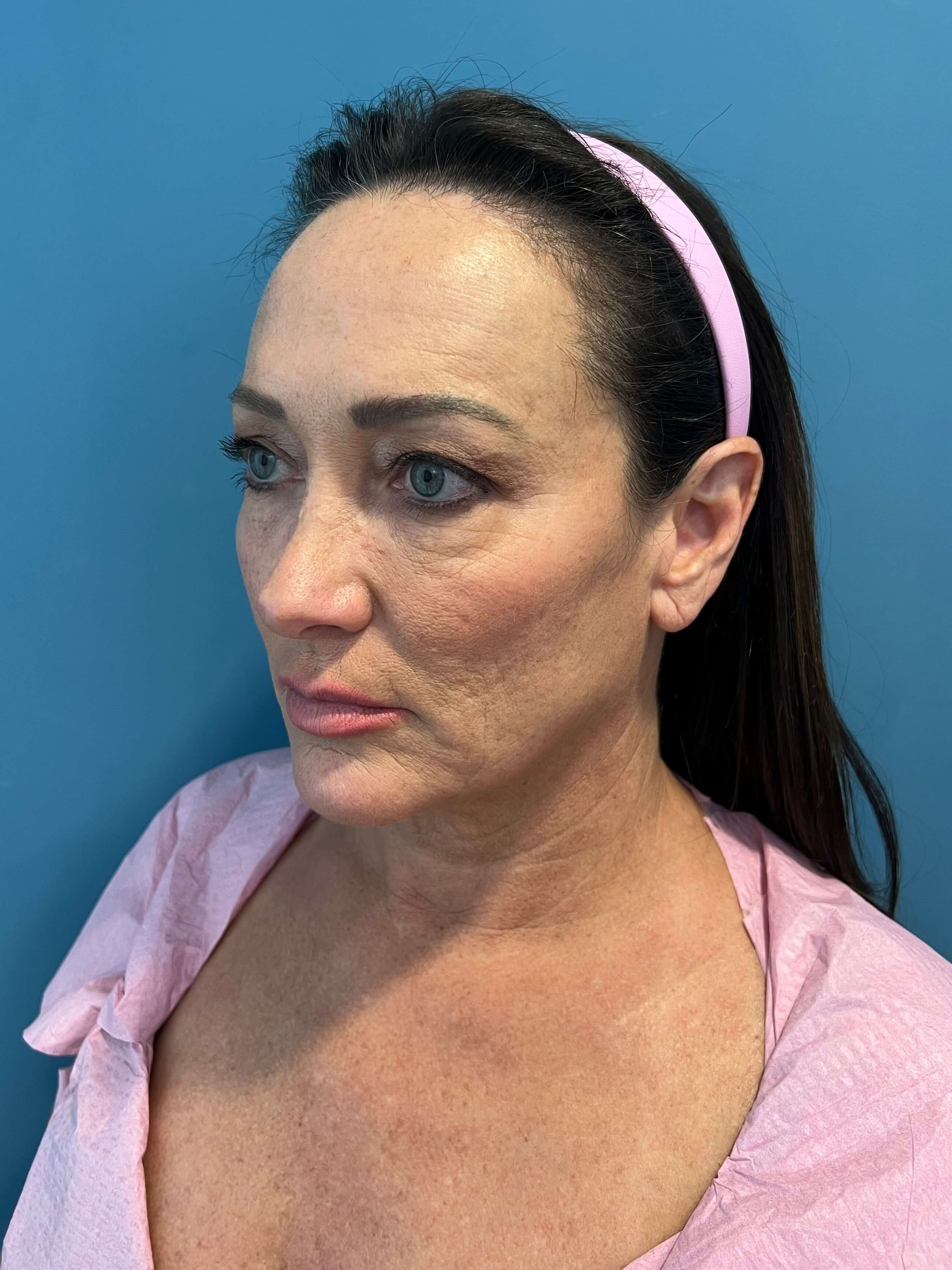 Deep Plane Face and Neck Lift with Upper and Lower Bleph, Lower with Fat Transposition — before, view 5