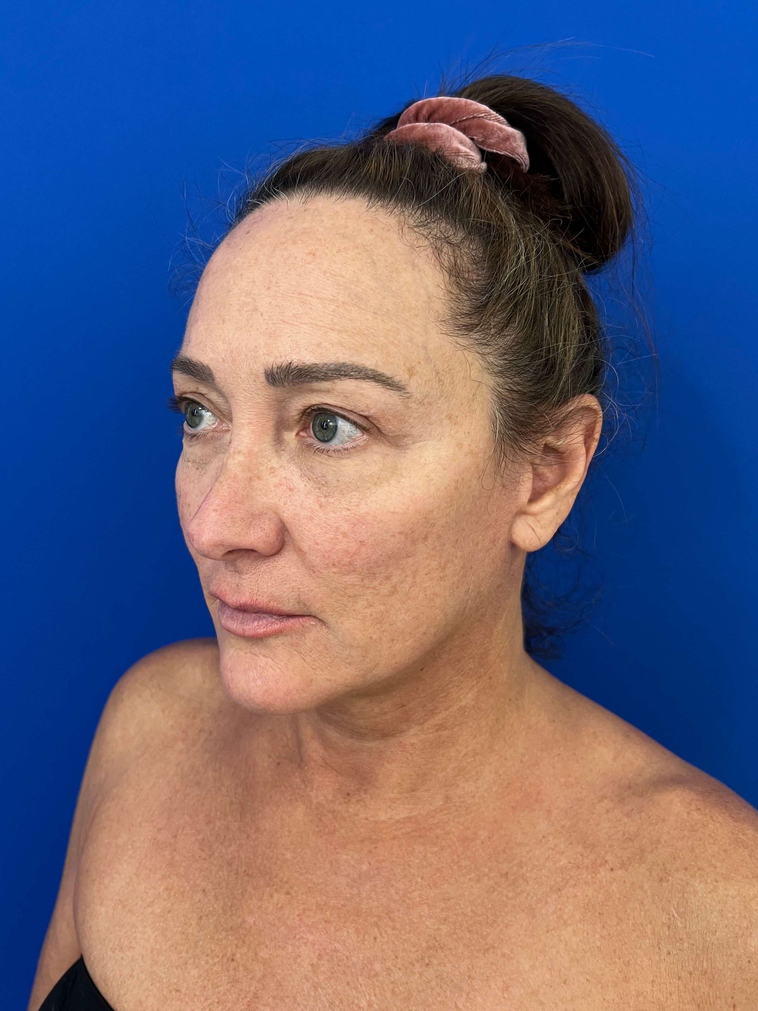 Deep Plane Face and Neck Lift with Upper and Lower Bleph, Lower with Fat Transposition — after, view 5