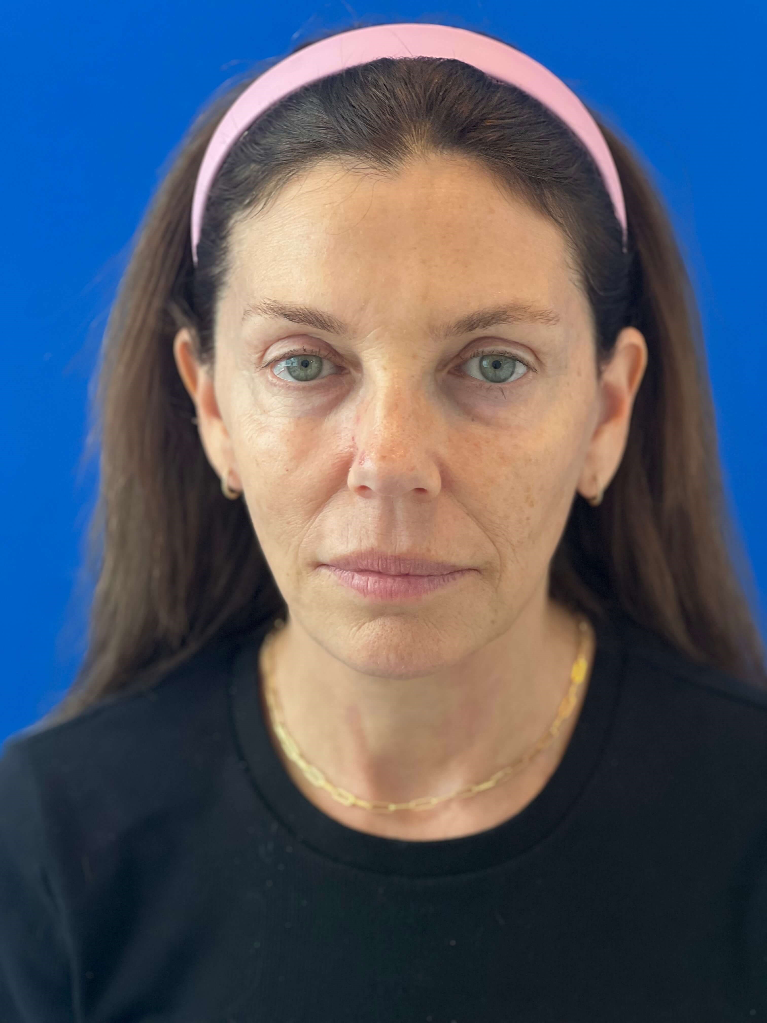 Beverly Hills, CA Patient Receives Facelift, Neck Lift