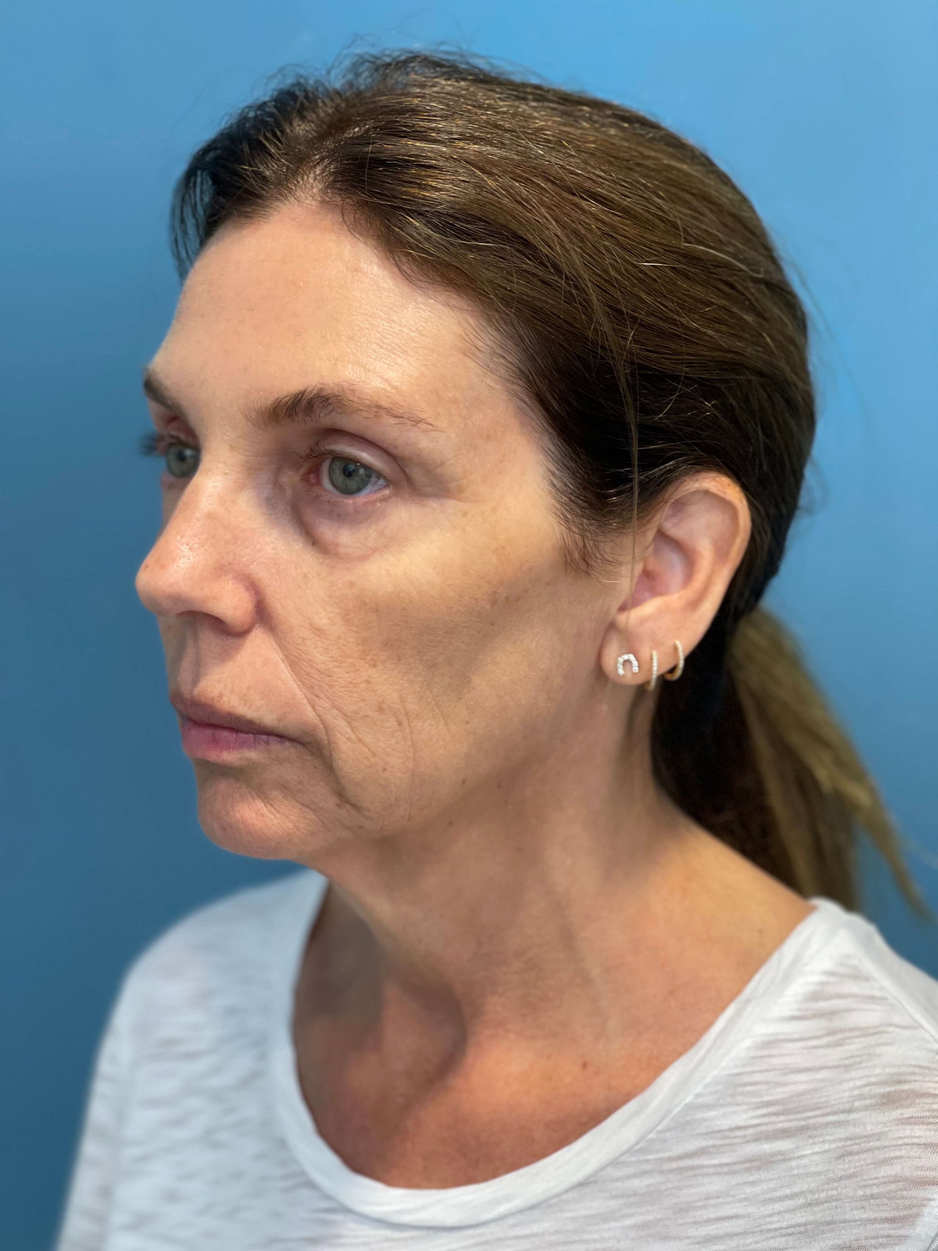 Beverly Hills, CA Patient Receives Facelift, Neck Lift — before, view 2