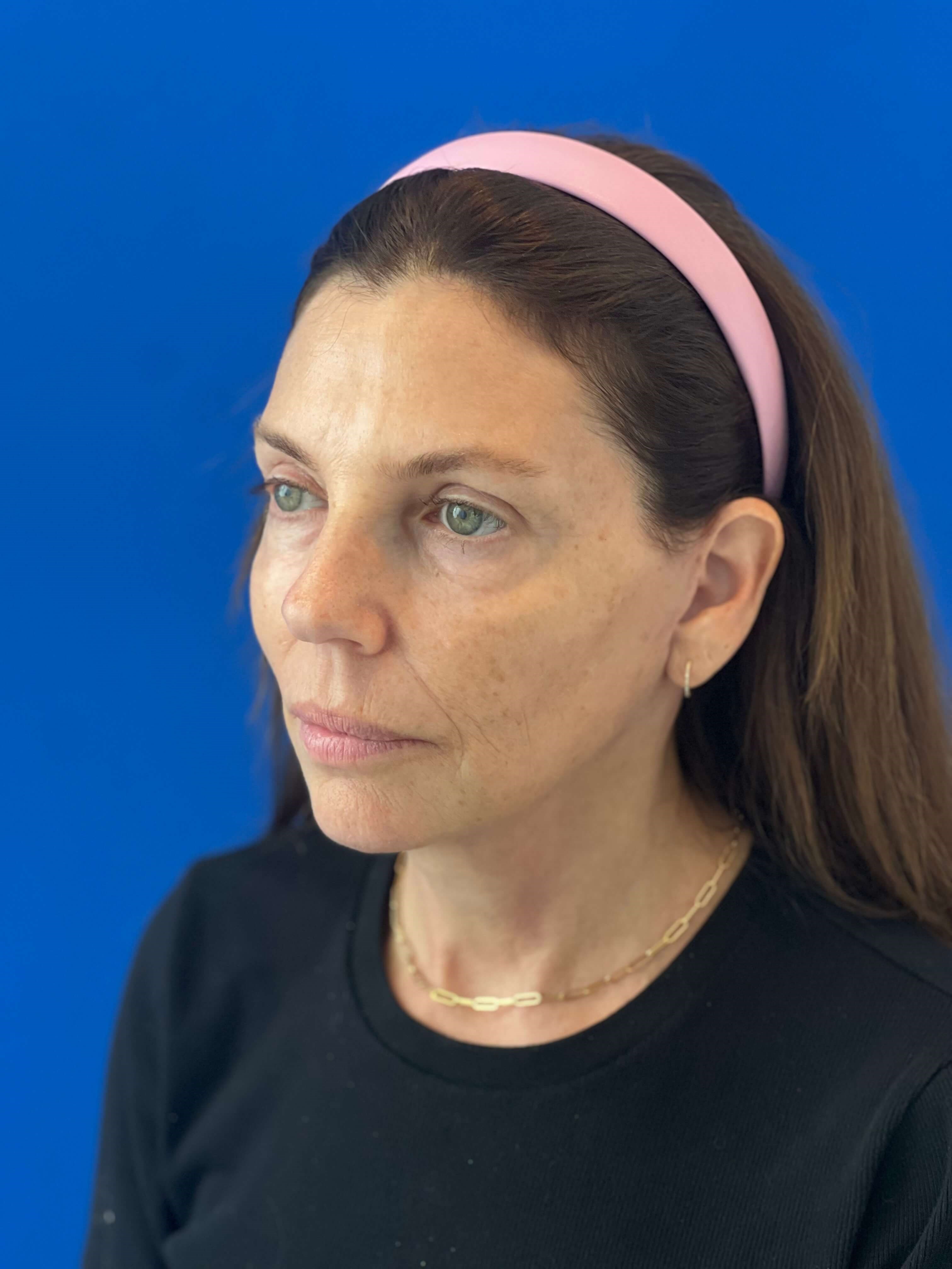 Beverly Hills, CA Patient Receives Facelift, Neck Lift — after, view 2