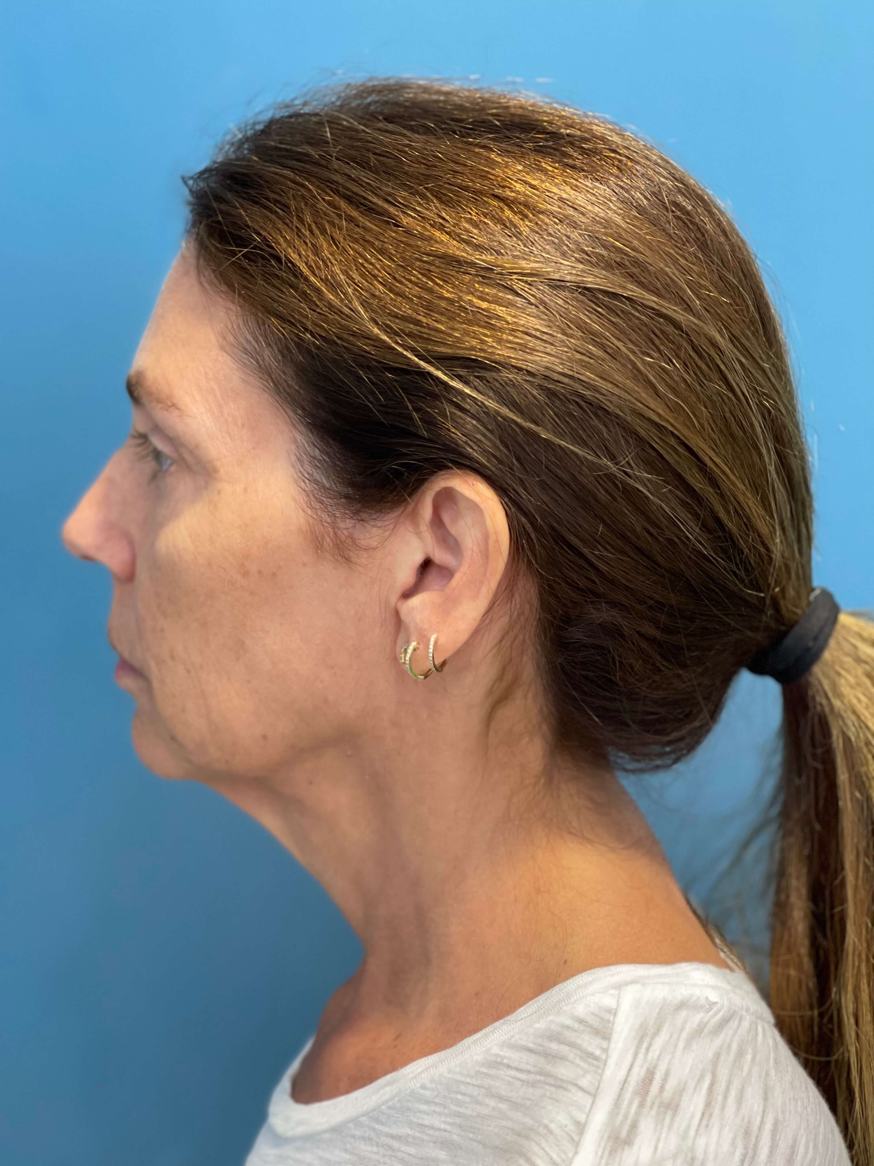 Beverly Hills, CA Patient Receives Facelift, Neck Lift — before, view 3