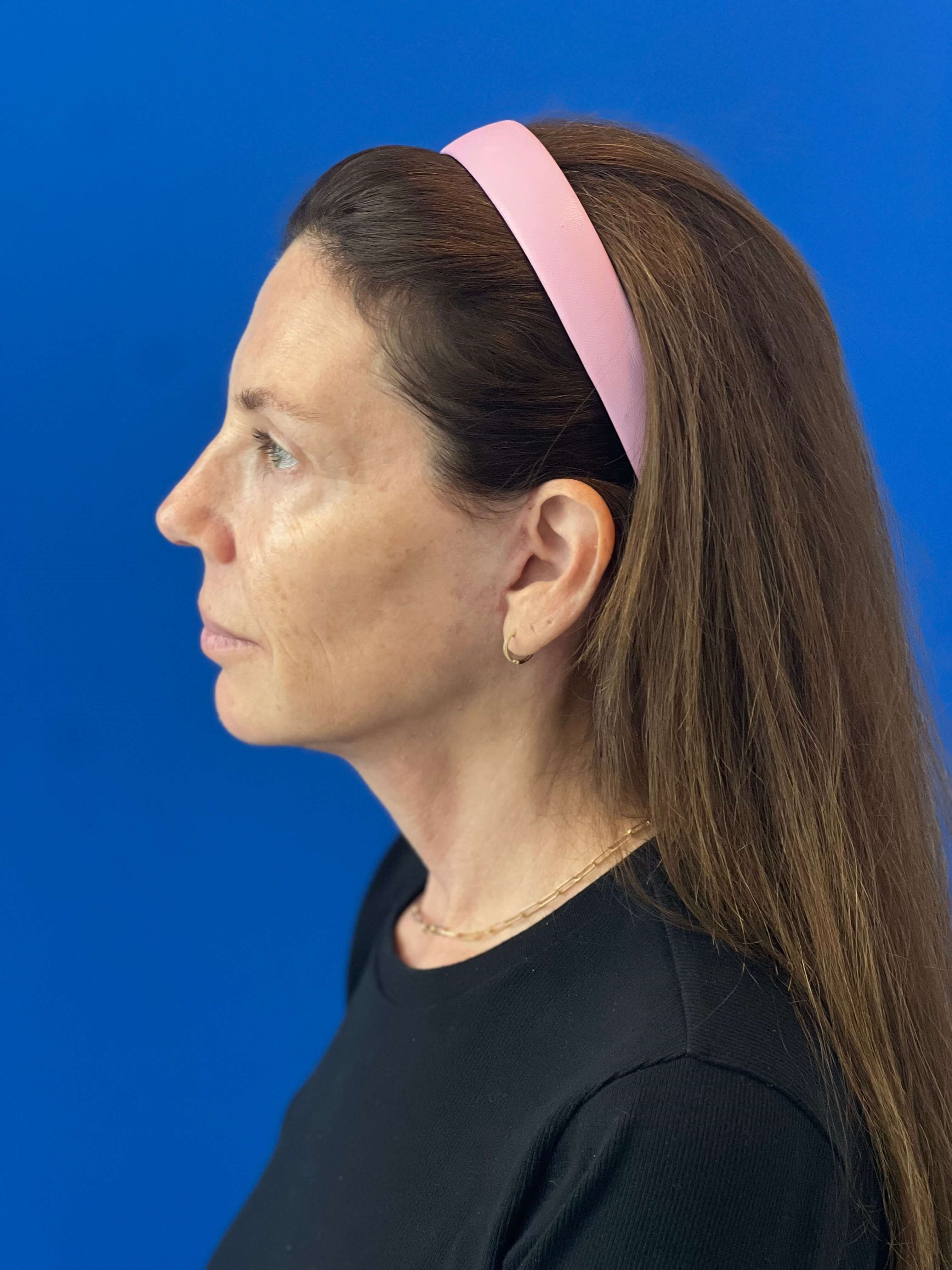 Beverly Hills, CA Patient Receives Facelift, Neck Lift — after, view 3