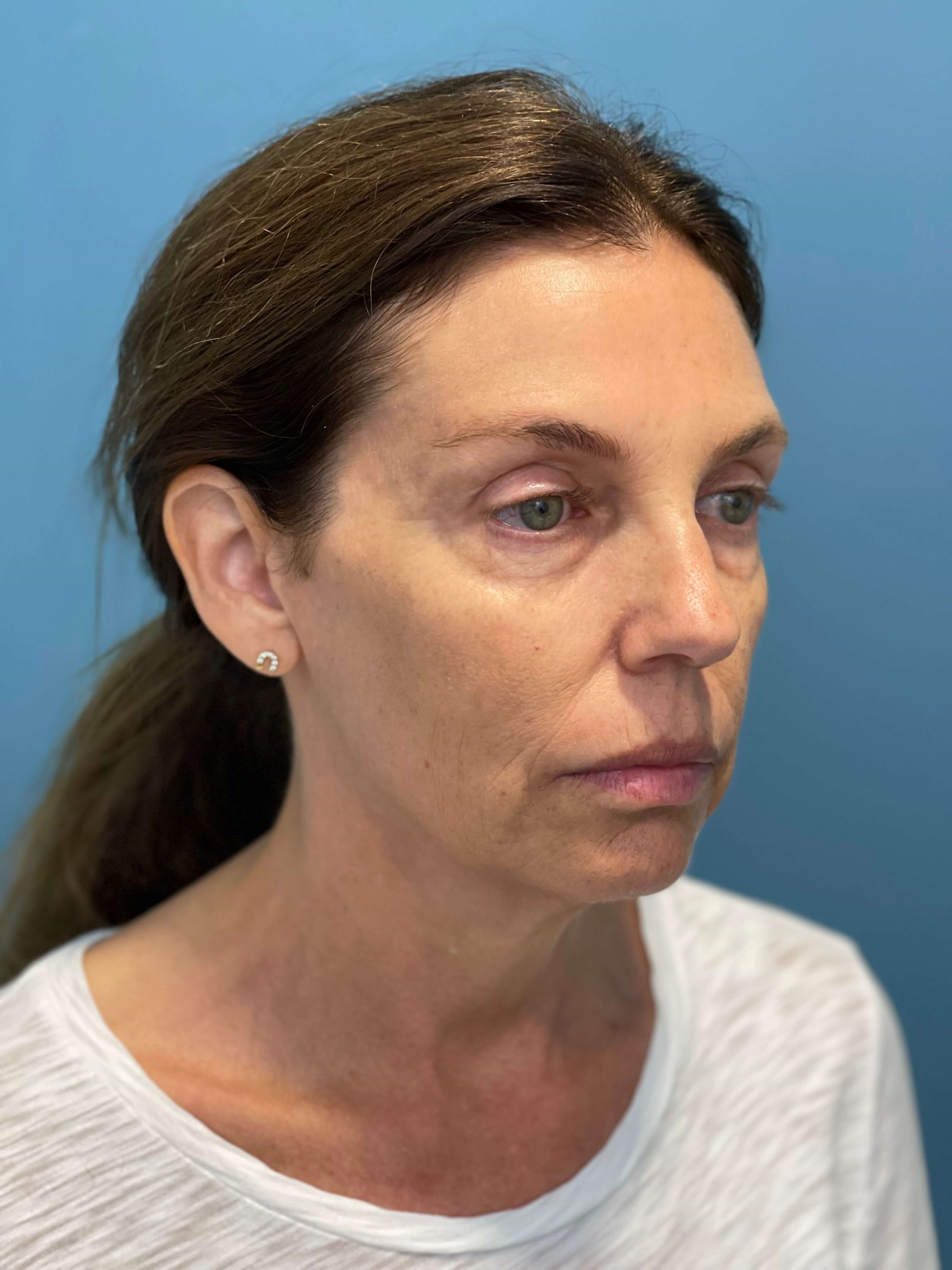Beverly Hills, CA Patient Receives Facelift, Neck Lift — before, view 4