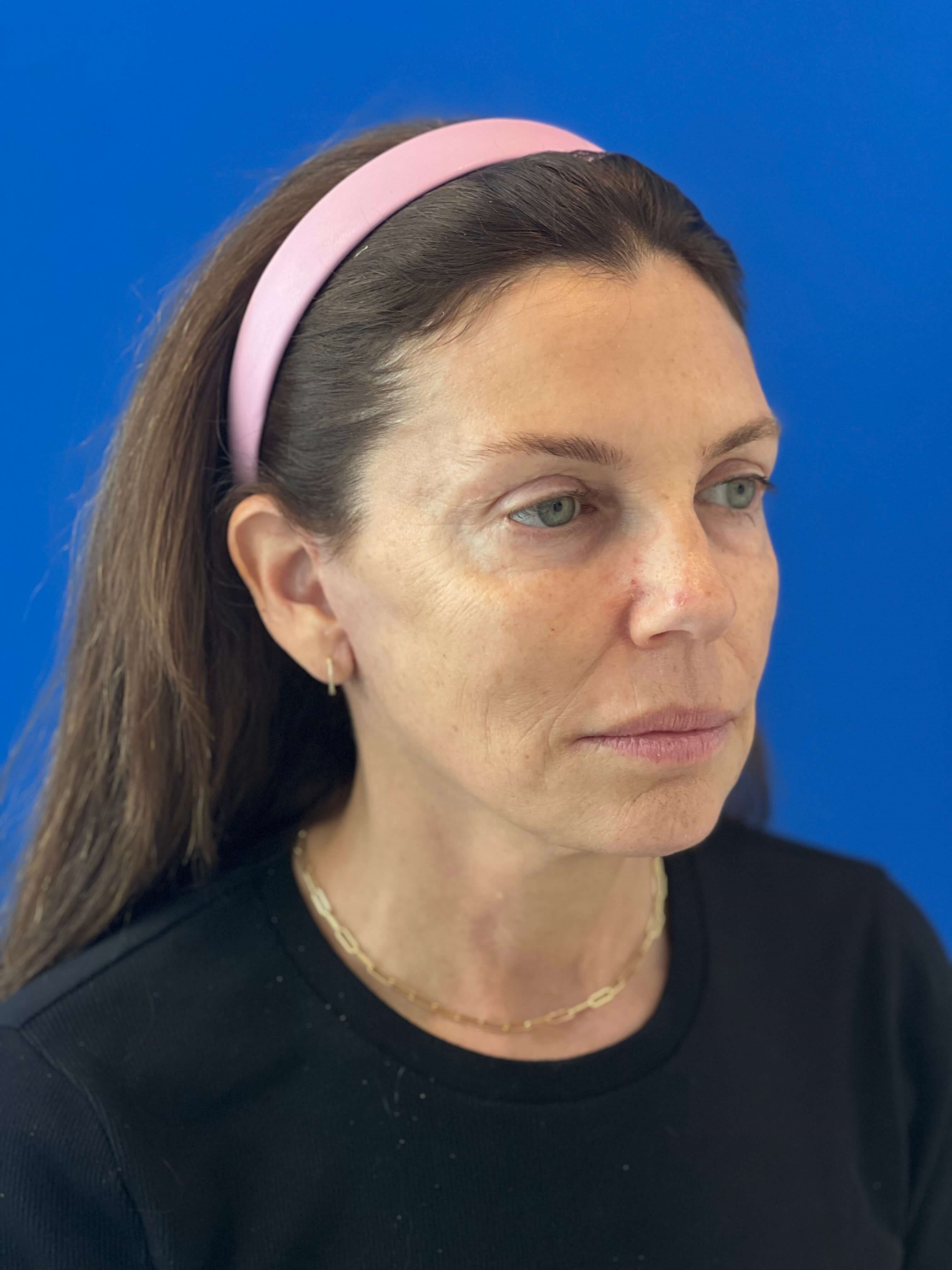 Beverly Hills, CA Patient Receives Facelift, Neck Lift — after, view 4