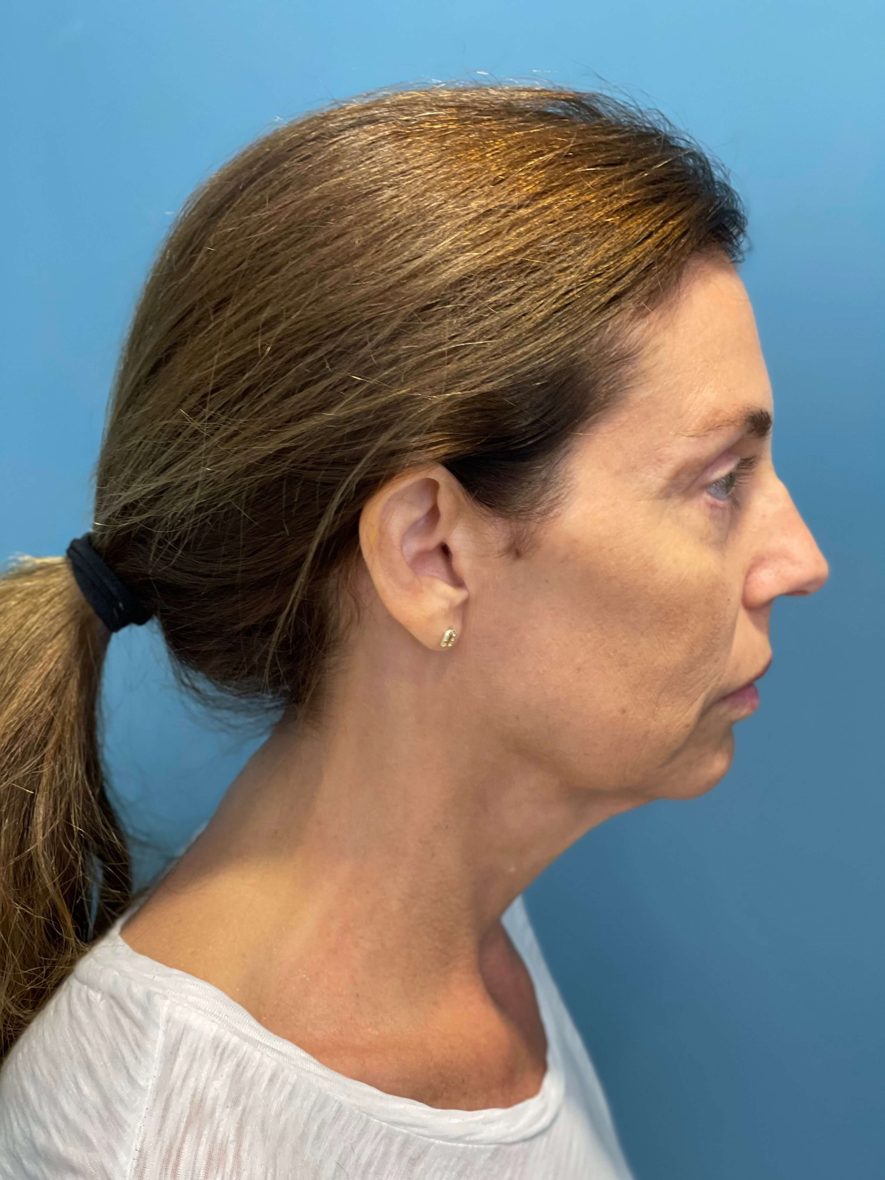 Beverly Hills, CA Patient Receives Facelift, Neck Lift — before, view 5