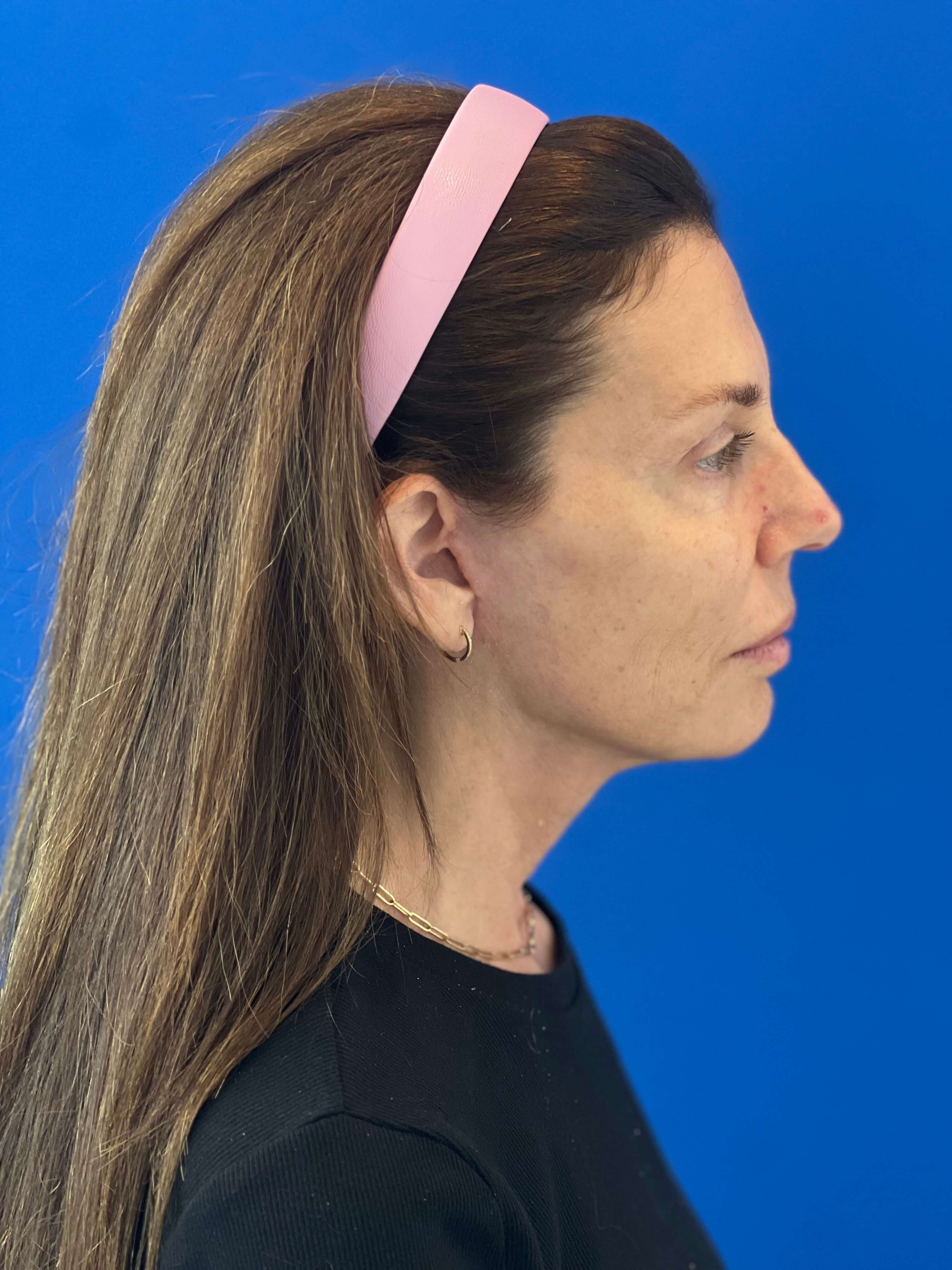 Beverly Hills, CA Patient Receives Facelift, Neck Lift — after, view 5