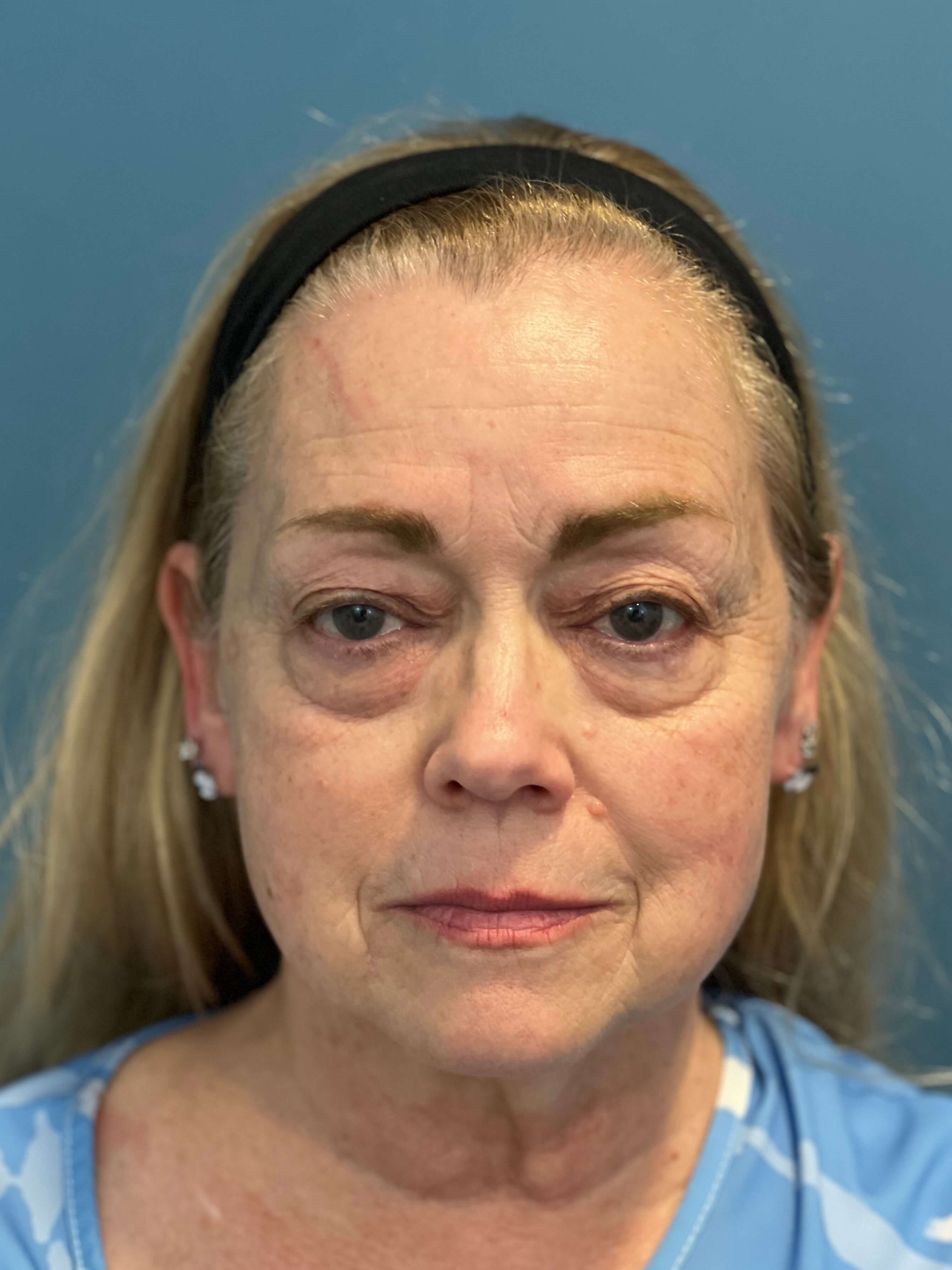Deep Plane Facelift, Neck Lift & Eyelid Rejuvenation for a Patient in Her 70s — before, view 1