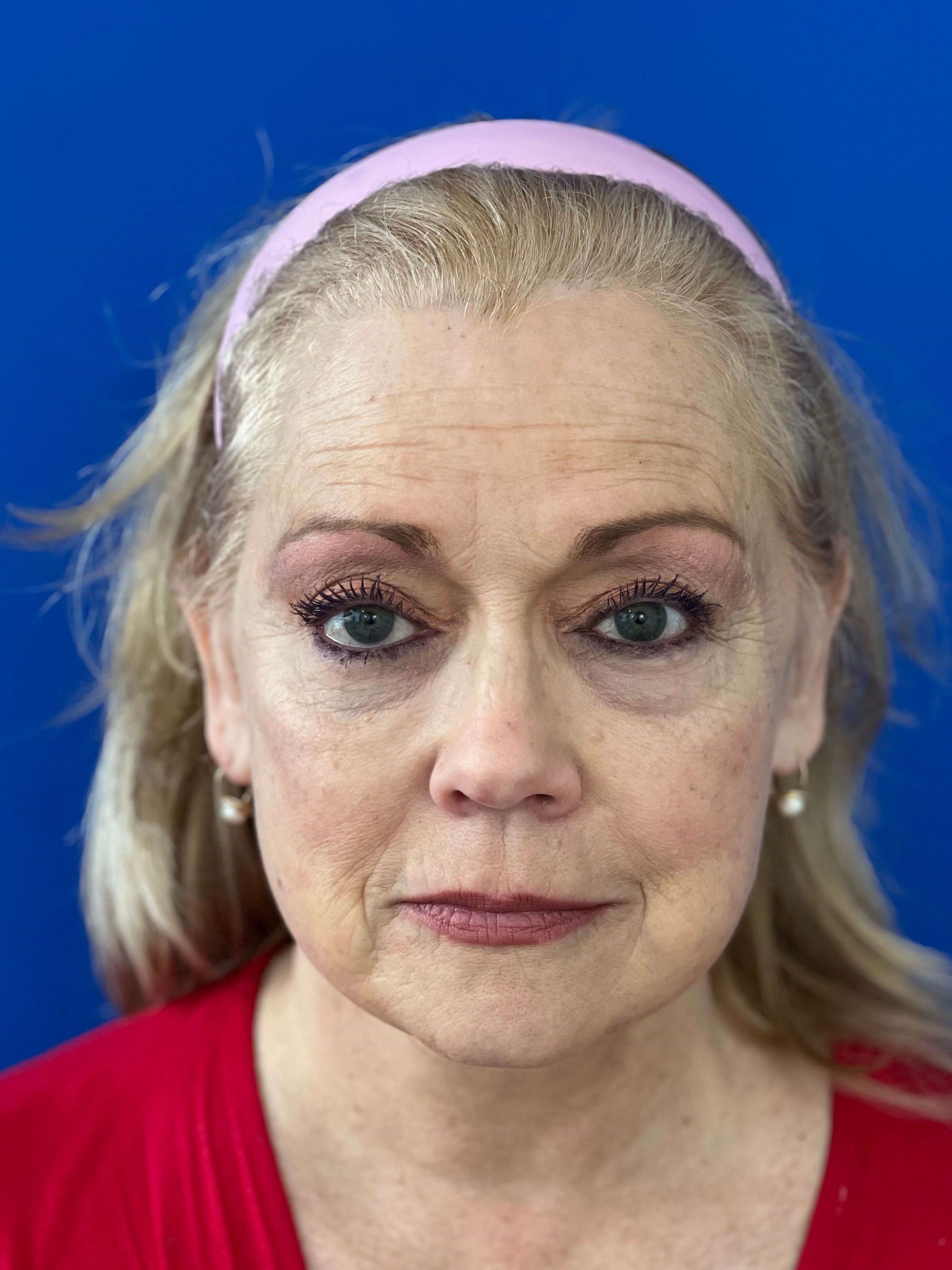 Deep Plane Facelift, Neck Lift & Eyelid Rejuvenation for a Patient in Her 70s — before, view 2