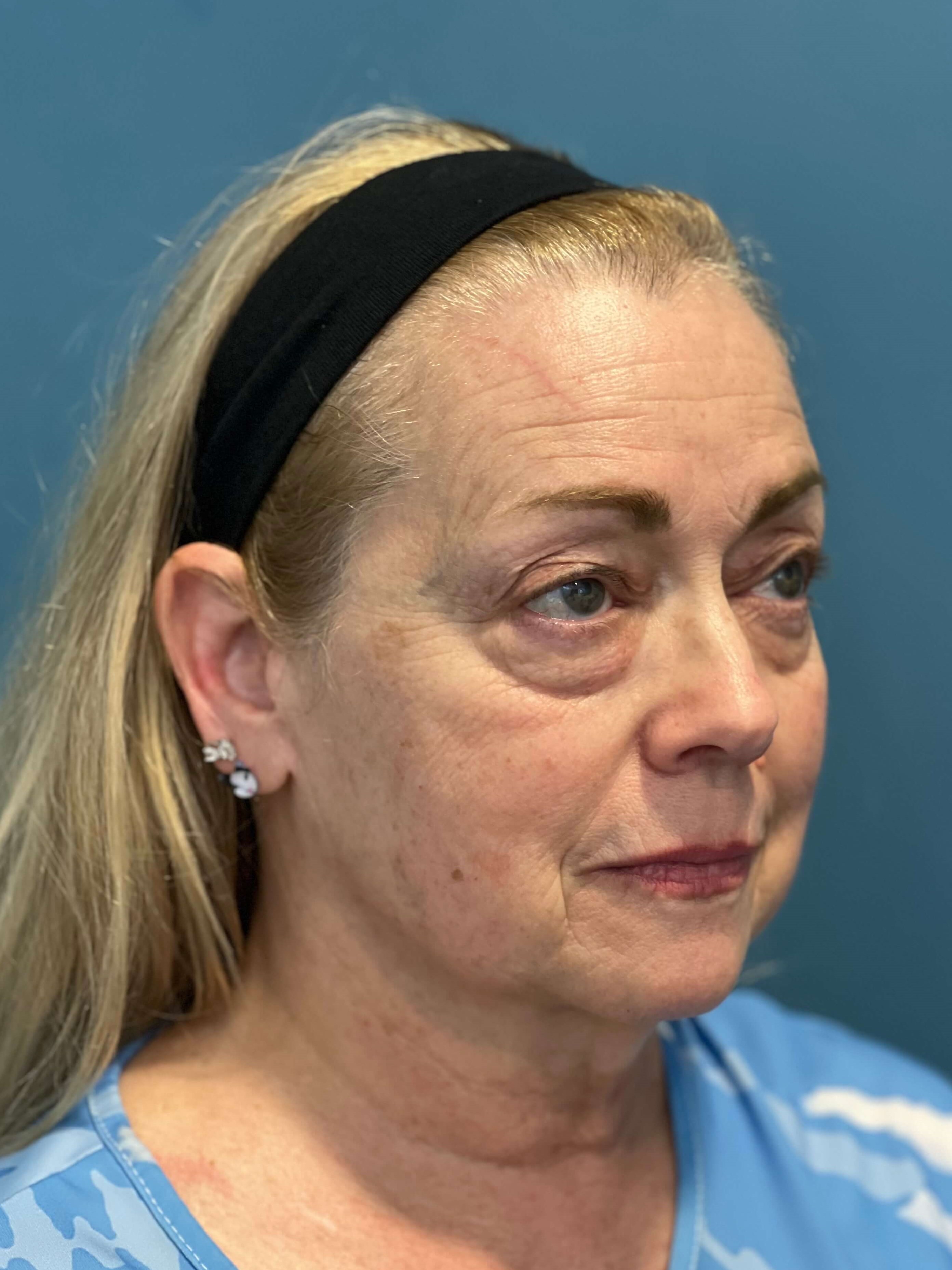 Deep Plane Facelift, Neck Lift & Eyelid Rejuvenation for a Patient in Her 70s — before, view 3