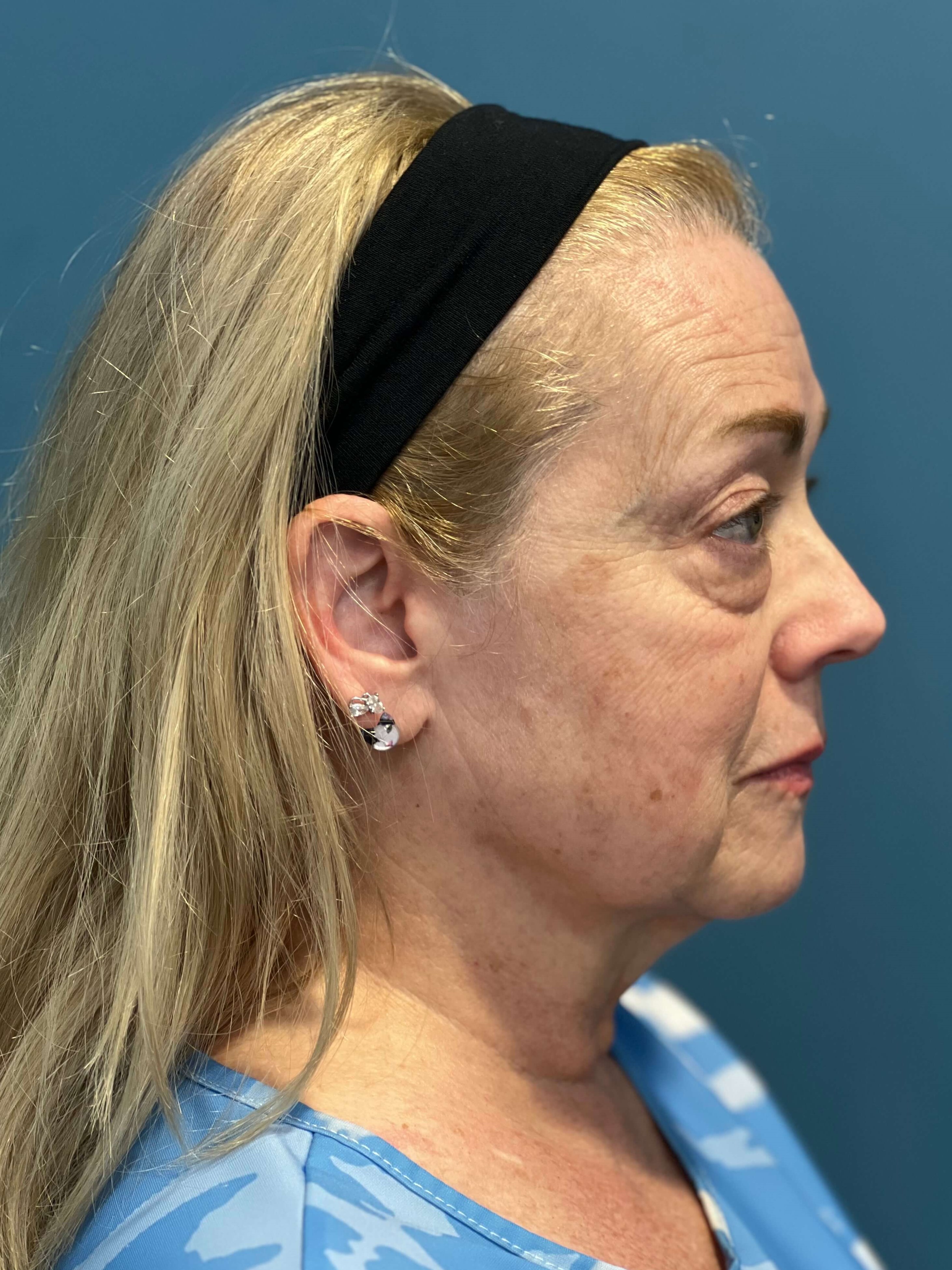 Deep Plane Facelift, Neck Lift & Eyelid Rejuvenation for a Patient in Her 70s — before, view 5