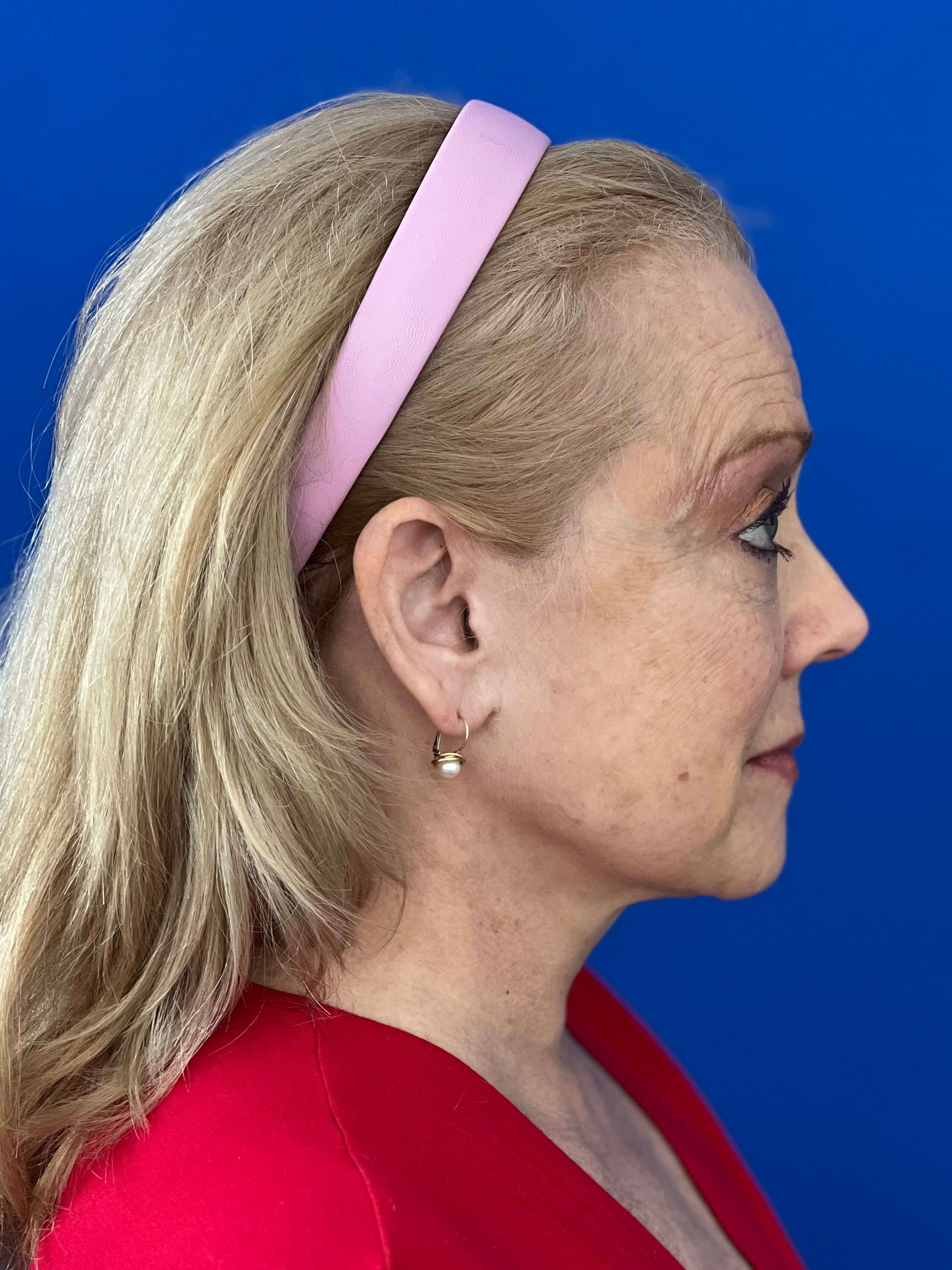 Deep Plane Facelift, Neck Lift & Eyelid Rejuvenation for a Patient in Her 70s