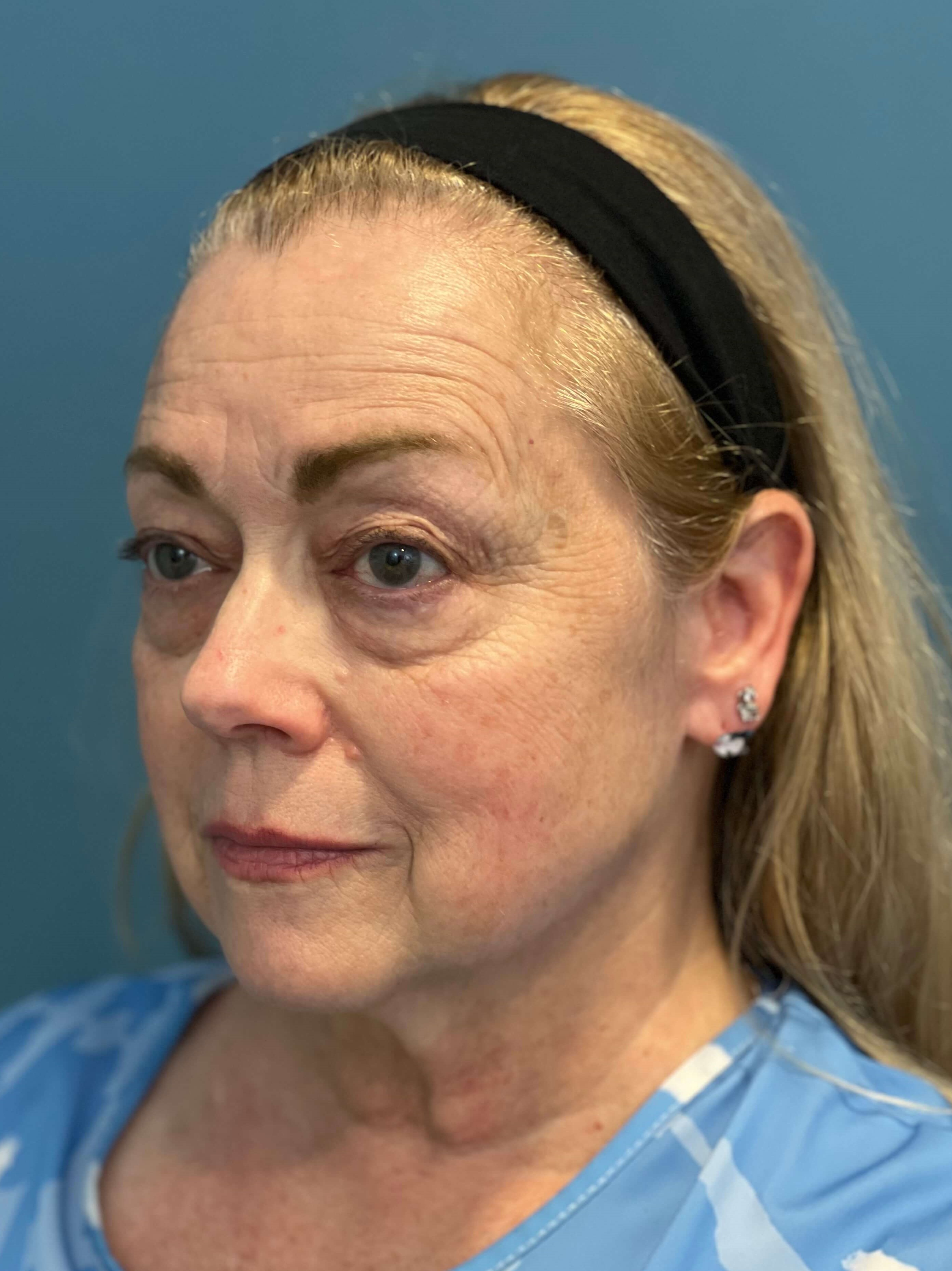 Deep Plane Facelift, Neck Lift & Eyelid Rejuvenation for a Patient in Her 70s — after, view 2