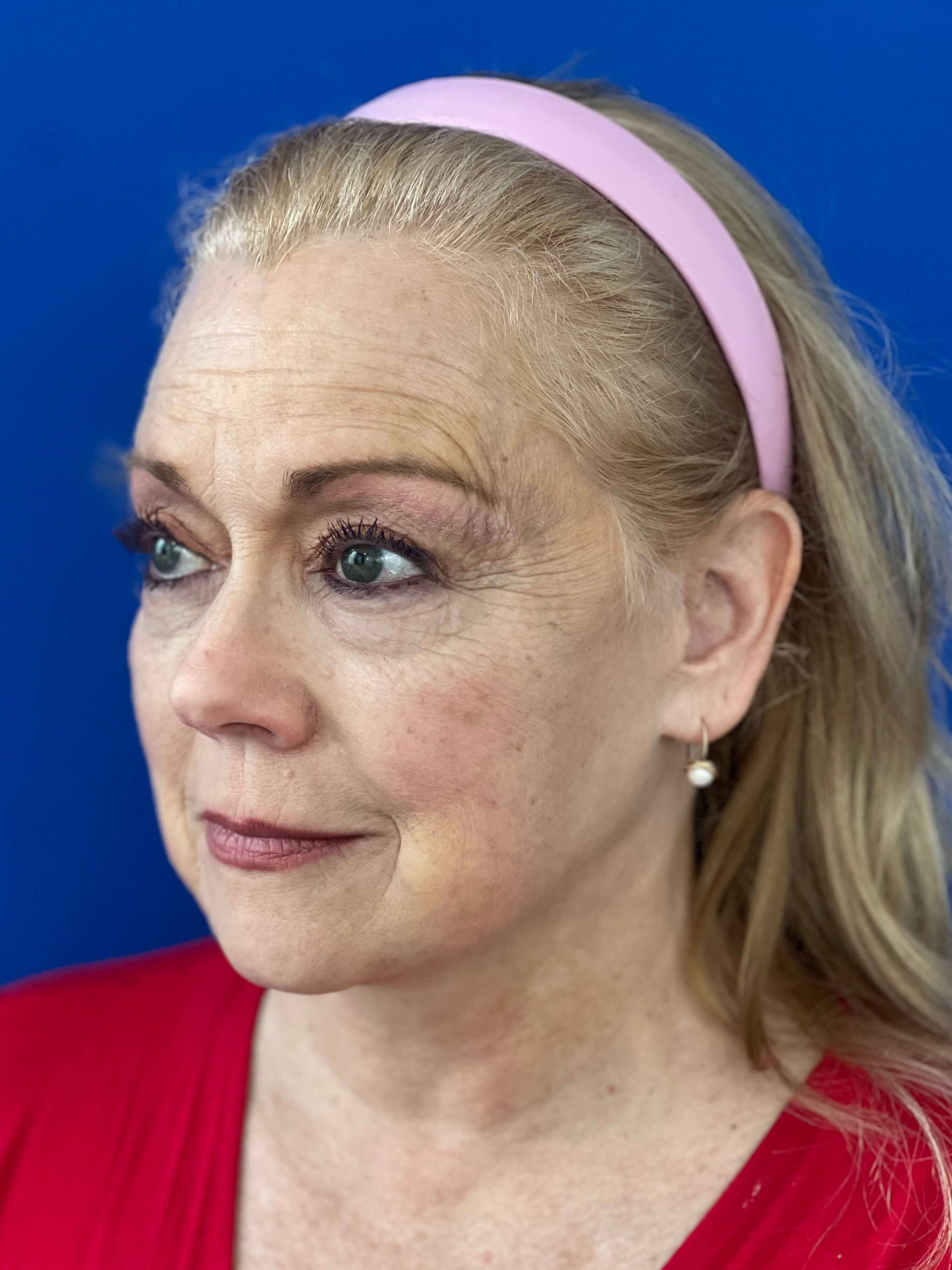 Deep Plane Facelift, Neck Lift & Eyelid Rejuvenation for a Patient in Her 70s — after, view 3