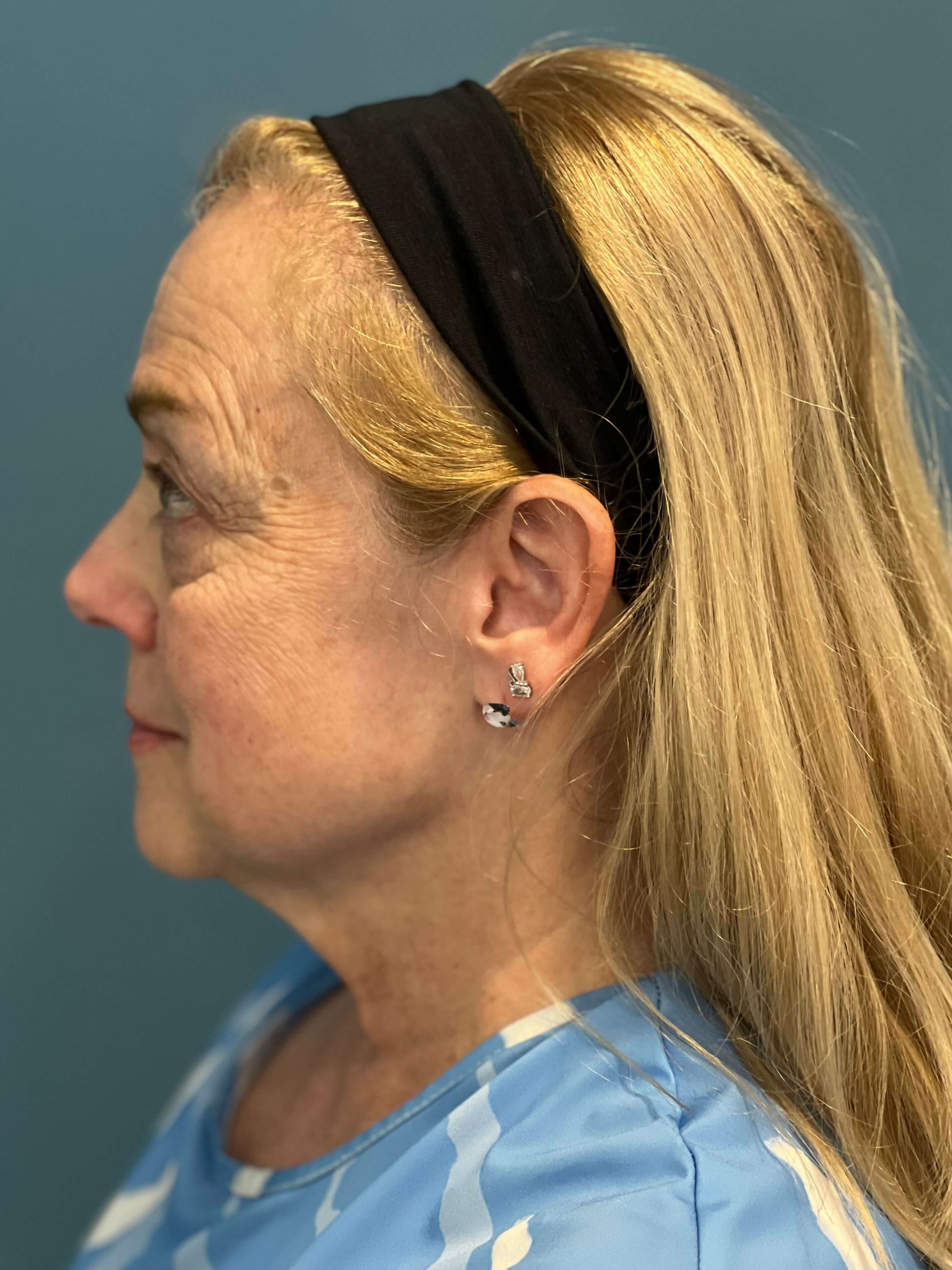 Deep Plane Facelift, Neck Lift & Eyelid Rejuvenation for a Patient in Her 70s — after, view 4
