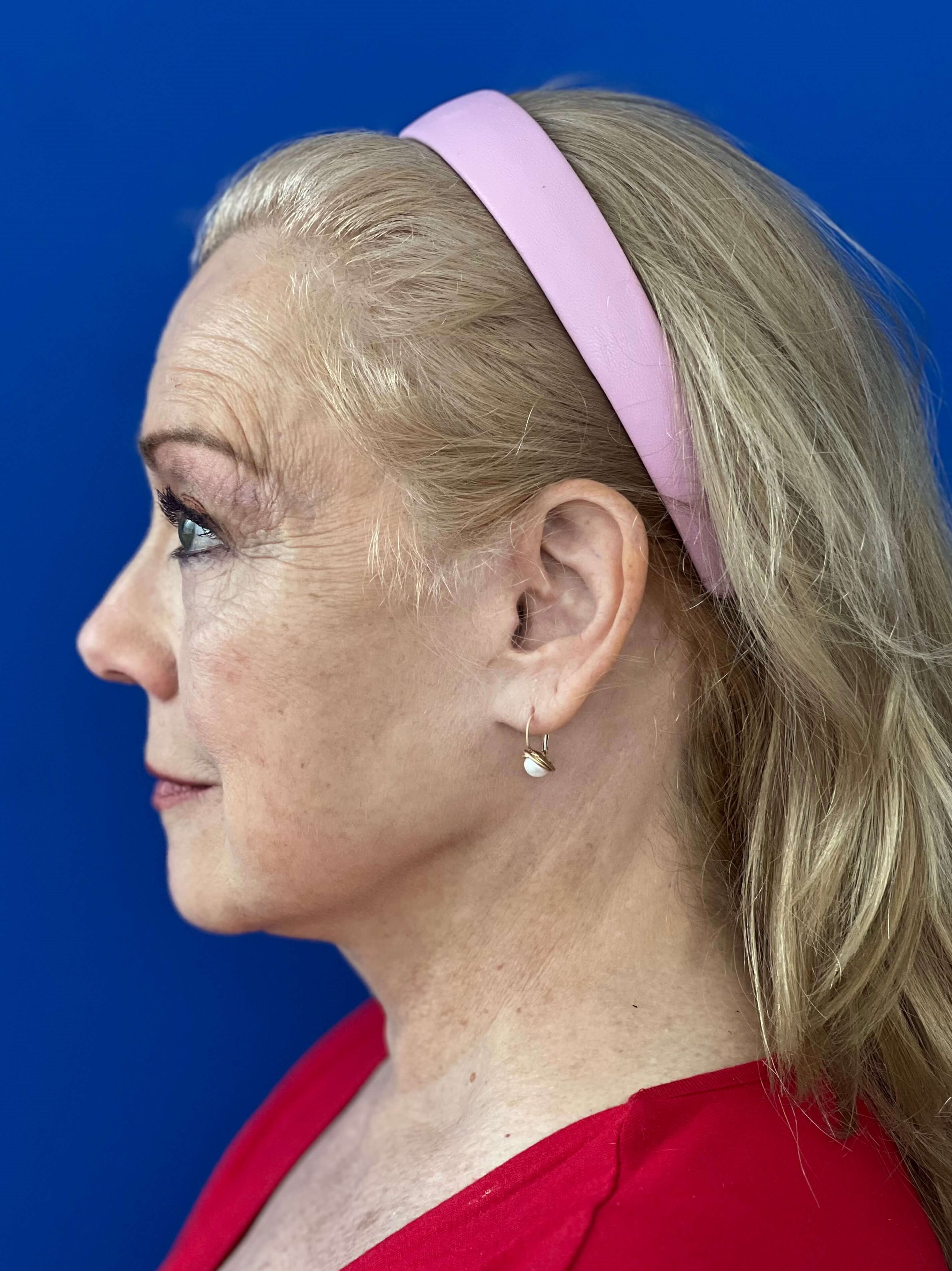 Deep Plane Facelift, Neck Lift & Eyelid Rejuvenation for a Patient in Her 70s — after, view 5