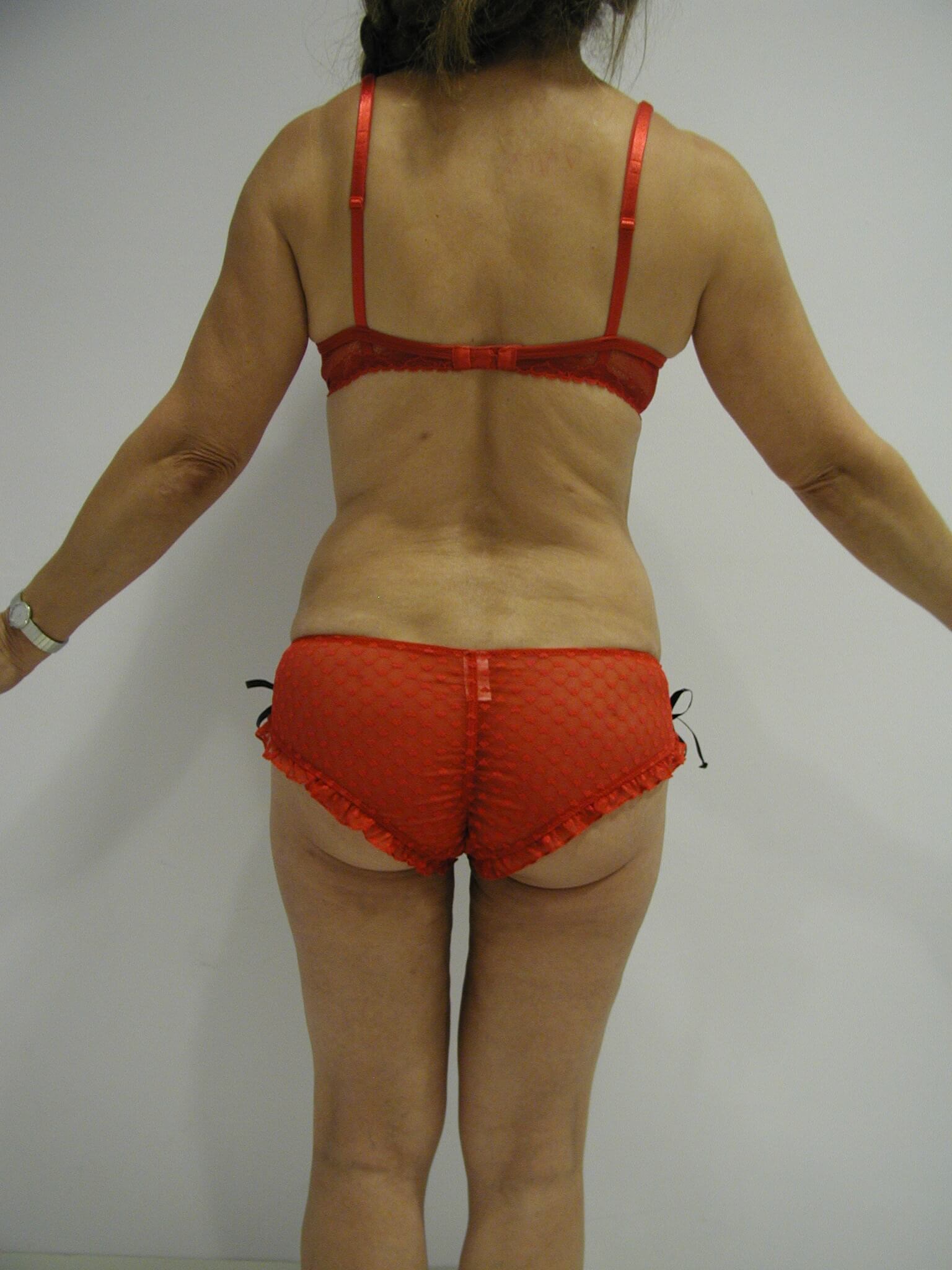Abdominoplasty with Liposuction — after, view 4