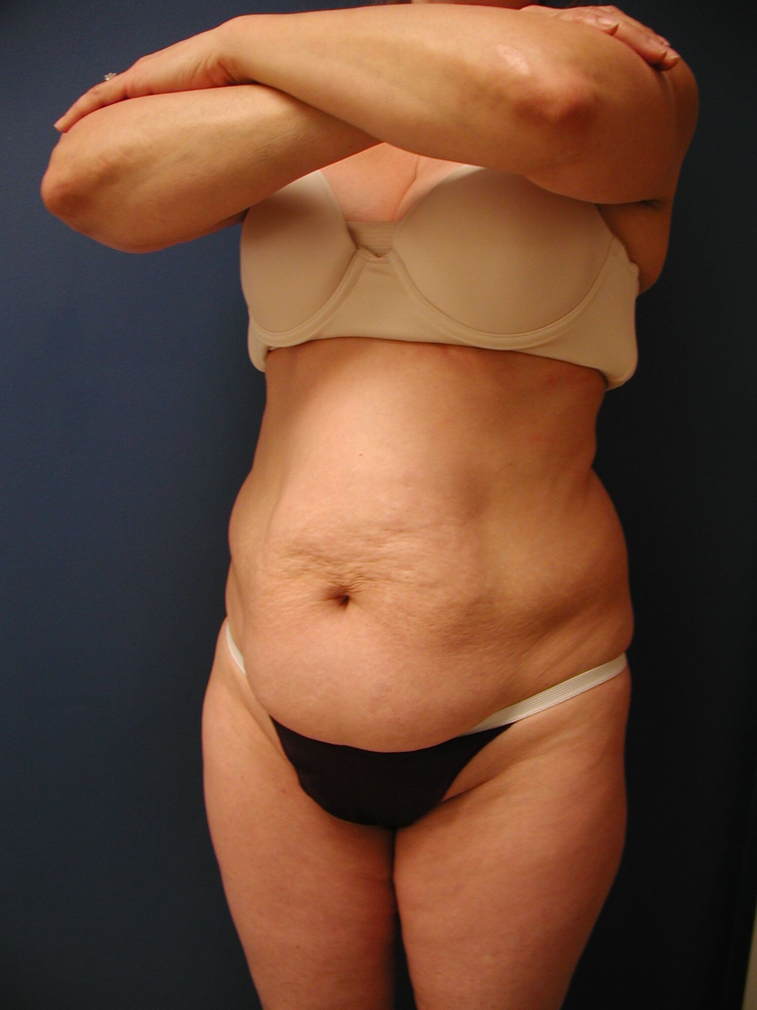 Abdominoplasty with Liposuction — before, view 3