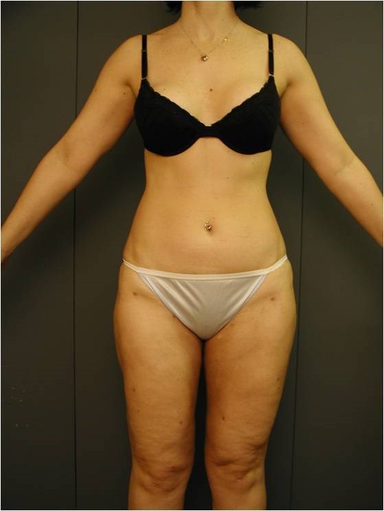 Lower Body Liposuction — after, view 1