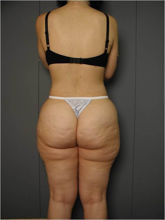 Lower Body Liposuction — before, view 2