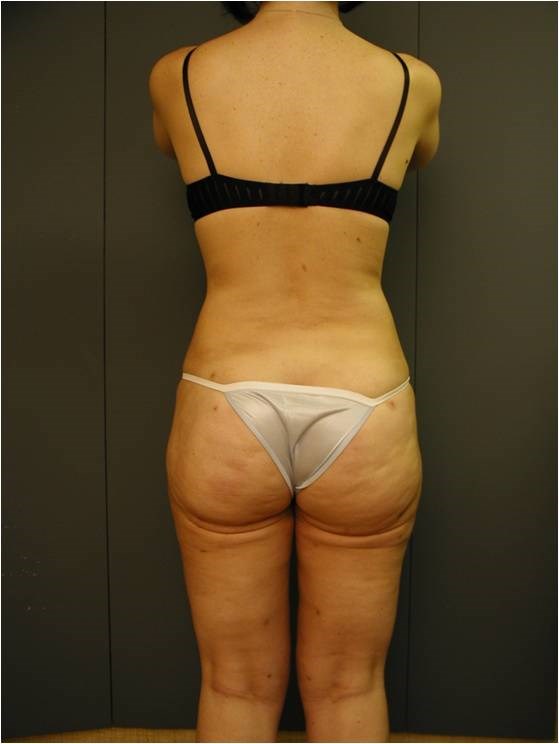 Lower Body Liposuction — after, view 2