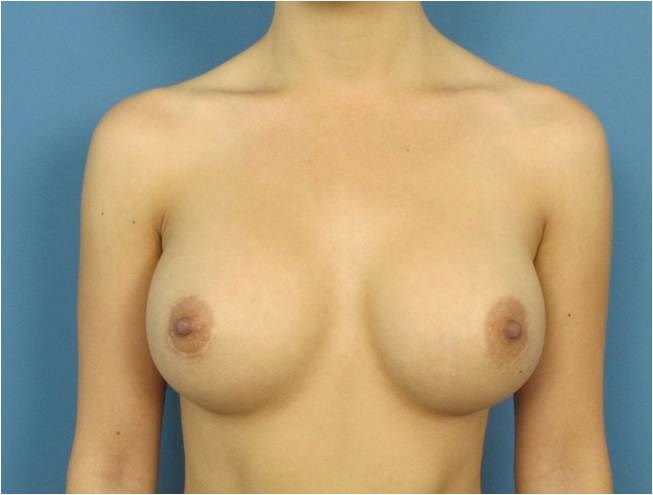 Breast Augmentation From A to Full C Cup - Beverly Hills, CA