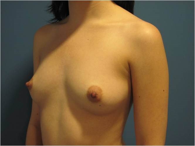 Breast Augmentation From A to Full C Cup - Beverly Hills, CA — before, view 2