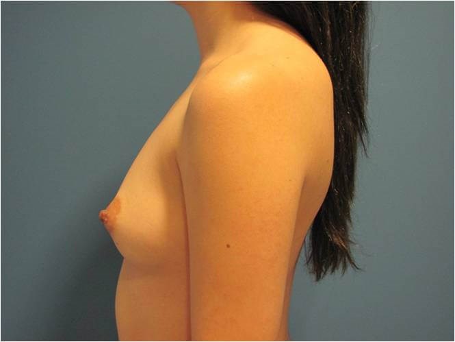 Breast Augmentation From A to Full C Cup - Beverly Hills, CA — before, view 3