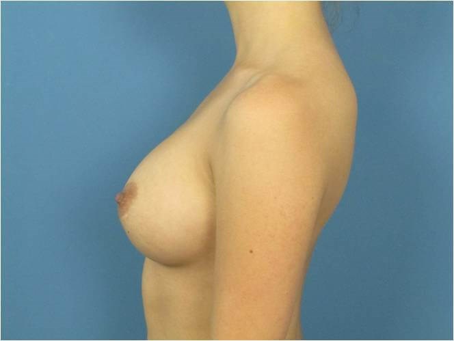 Breast Augmentation From A to Full C Cup - Beverly Hills, CA — after, view 3