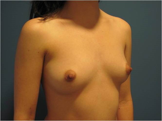 Breast Augmentation From A to Full C Cup - Beverly Hills, CA — before, view 4