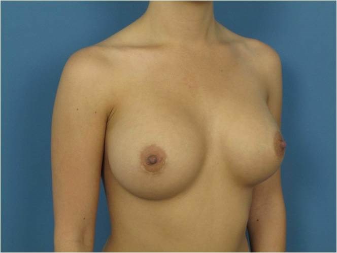 Breast Augmentation From A to Full C Cup - Beverly Hills, CA — after, view 4