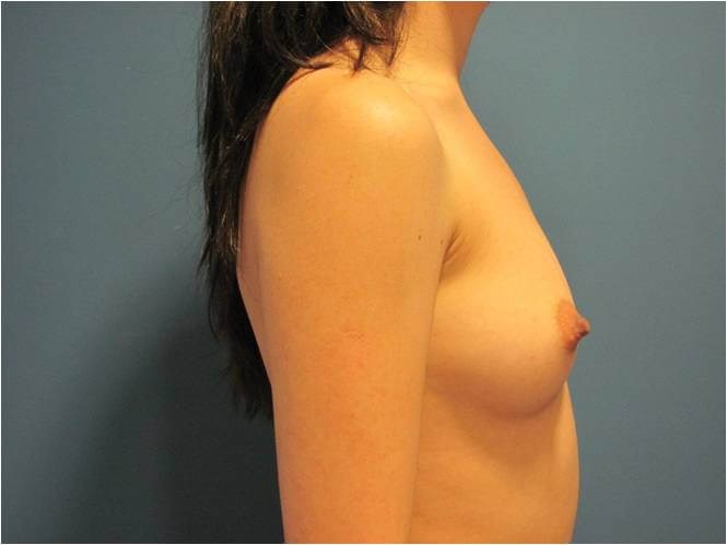 Breast Augmentation From A to Full C Cup - Beverly Hills, CA — before, view 5