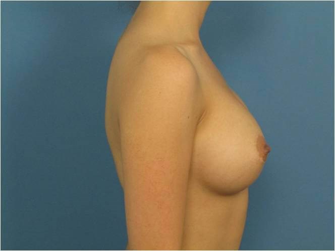 Breast Augmentation From A to Full C Cup - Beverly Hills, CA — after, view 5