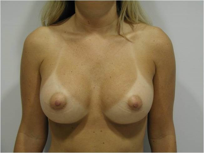 Breast Augmentation From A to C Cup
